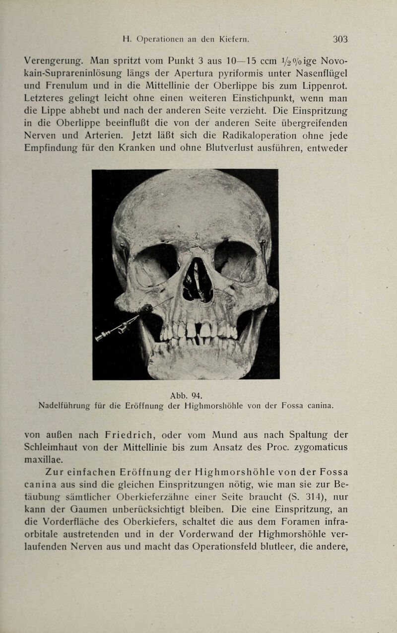 Verengerung. Man spritzt vom Punkt 3 aus 10—15 ccm Vatyoige Novo- kain-Suprareninlösung längs der Apertura pyriformis unter Nasenflügel und Frenulum und in die Mittellinie der Oberlippe bis zum Lippenrot. Letzteres gelingt leicht ohne einen weiteren Einstichpunkt, wenn man die Lippe abhebt und nach der anderen Seite verzieht. Die Einspritzung in die Oberlippe beeinflußt die von der anderen Seite übergreifenden Nerven und Arterien. Jetzt läßt sich die Radikaloperation ohne jede Empfindung für den Kranken und ohne Blutverlust ausführen, entweder Abb. 94. Nadelführung für die Eröffnung der Highmorshöhle von der Fossa canina. von außen nach Friedrich, oder vom Mund aus nach Spaltung der Schleimhaut von der Mittellinie bis zum Ansatz des Proc. zygomaticus maxillae. Zur einfachen Eröffnung der Highmorshöhle von der Fossa canina aus sind die gleichen Einspritzungen nötig, wie man sie zur Be¬ täubung sämtlicher Oberkieferzähne einer Seite braucht (S. 314), nur kann der Gaumen unberücksichtigt bleiben. Die eine Einspritzung, an die Vorderfläche des Oberkiefers, schaltet die aus dem Foramen infra¬ orbitale austretenden und in der Vorderwand der Highmorshöhle ver¬ laufenden Nerven aus und macht das Operationsfeld blutleer, die andere,
