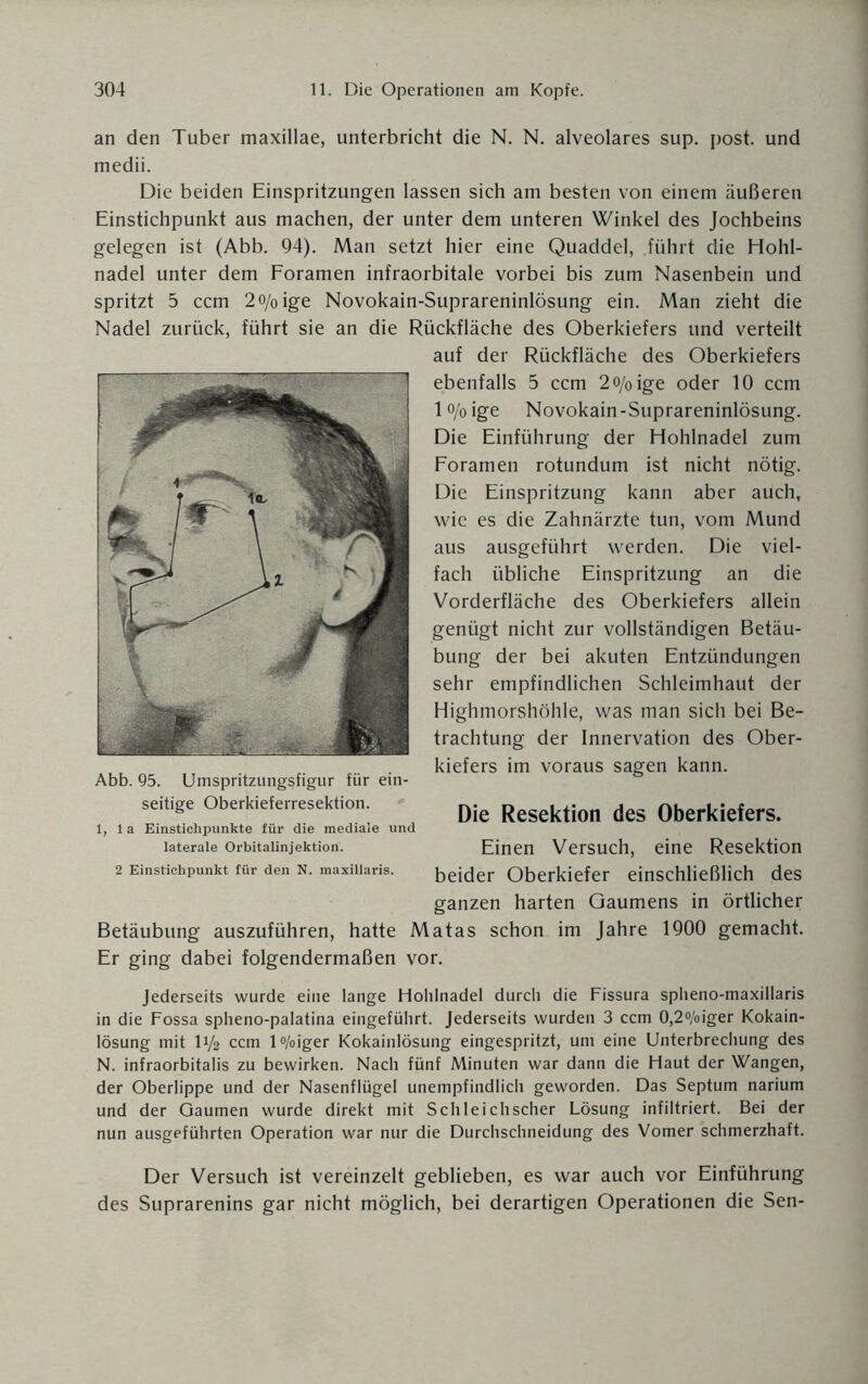 an den Tuber maxillae, unterbricht die N. N. alveolares sup. post, und medii. Die beiden Einspritzungen lassen sich am besten von einem äußeren Einstichpunkt aus machen, der unter dem unteren Winkel des Jochbeins gelegen ist (Abb. 94). Man setzt hier eine Quaddel, führt die Hohl¬ nadel unter dem Foramen infraorbitale vorbei bis zum Nasenbein und spritzt 5 ccm 2o/0ige Novokain-Suprareninlösung ein. Man zieht die Nadel zurück, führt sie an die Rückfläche des Oberkiefers und verteilt auf der Rückfläche des Oberkiefers ebenfalls 5 ccm 2o/0ige oder 10 ccm 1 o/o ige Novokain-Suprareninlösung. Die Einführung der Hohlnadel zum Foramen rotundum ist nicht nötig. Die Einspritzung kann aber auch, wie es die Zahnärzte tun, vom Mund aus ausgeführt werden. Die viel¬ fach übliche Einspritzung an die Vorderfläche des Oberkiefers allein genügt nicht zur vollständigen Betäu¬ bung der bei akuten Entzündungen sehr empfindlichen Schleimhaut der Highmorshöhle, was man sich bei Be¬ trachtung der Innervation des Ober¬ kiefers im voraus sagen kann. Die Resektion des Oberkiefers. 1,1a Einstichpunkte für die mediaie und laterale Orbitalinjektion. Einen Versuch, eine Resektion 2 Einstichpunkt für den n. maxiiiaris. beider Oberkiefer einschließlich des ganzen harten Gaumens in örtlicher Betäubung auszuführen, hatte Matas schon im Jahre 1900 gemacht. Er ging dabei folgendermaßen vor. Abb. 95. Umspritzungsfigur für ein¬ seitige Oberkieferresektion. Jederseits wurde eine lange Hohlnadel durch die Fissura spheno-maxillaris in die Fossa spheno-palatina eingeführt. Jederseits wurden 3 ccm 0,2%iger Kokain¬ lösung mit I1/2 ccm l°/oiger Kokainlösung eingespritzt, um eine Unterbrechung des N. infraorbitalis zu bewirken. Nach fünf Minuten war dann die Haut der Wangen, der Oberlippe und der Nasenflügel unempfindlich geworden. Das Septum narium und der Gaumen wurde direkt mit Schleichscher Lösung infiltriert. Bei der nun ausgeführten Operation war nur die Durchschneidung des Vomer schmerzhaft. Der Versuch ist vereinzelt geblieben, es war auch vor Einführung des Suprarenins gar nicht möglich, bei derartigen Operationen die Sen-