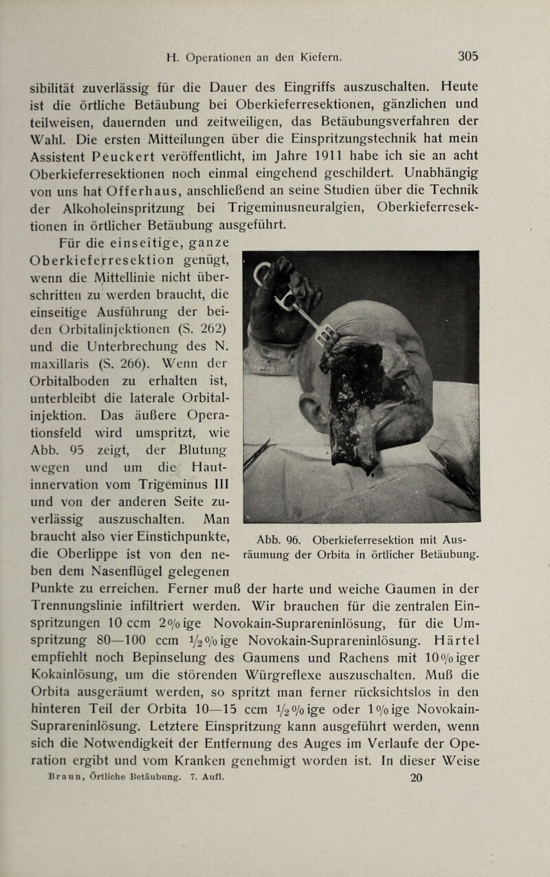 sibilität zuverlässig für die Dauer des Eingriffs auszuschalten. Heute ist die örtliche Betäubung bei Oberkieferresektionen, gänzlichen und teilweisen, dauernden und zeitweiligen, das Betäubungsverfahren der Wahl. Die ersten Mitteilungen über die Einspritzungstechnik hat mein Assistent Peuckert veröffentlicht, im Jahre 1911 habe ich sie an acht Oberkieferresektionen noch einmal eingehend geschildert. Unabhängig von uns hat Offerhaus, anschließend an seine Studien über die Technik der Alkoholeinspritzung bei Trigeminusneuralgien, Oberkieferresek¬ tionen in örtlicher Betäubung ausgeführt. Für die einseitige, ganze Oberkieferresektion genügt, wenn die Mittellinie nicht über¬ schritten zu werden braucht, die einseitige Ausführung der bei¬ den Orbitalinjektionen (S. 262) und die Unterbrechung des N. maxillaris (S. 266). Wenn der Orbitalboden zu erhalten ist, unterbleibt die laterale Orbital¬ injektion. Das äußere Opera¬ tionsfeld wird umspritzt, wie Abb. 95 zeigt, der Blutung wegen und um die Haut¬ innervation vom Trigeminus III und von der anderen Seite zu¬ verlässig auszuschalten. Man braucht also vier Einstichpunkte, die Oberlippe ist von den ne¬ ben dem Nasenflügel gelegenen Punkte zu erreichen. Ferner muß der harte und weiche Gaumen in der Trennungslinie infiltriert werden. Wir brauchen für die zentralen Ein¬ spritzungen 10 ccm 2o/oige Novokain-Suprareninlösung, für die Um¬ spritzung 80—100 ccm V2%ige Novokain-Suprareninlösung. Härtel empfiehlt noch Bepinselung des Gaumens und Rachens mit 10o/0iger Kokainlösung, um die störenden Würgreflexe auszuschalten. Muß die Orbita ausgeräumt werden, so spritzt man ferner rücksichtslos in den hinteren Teil der Orbita 10—15 ccm YgO/o.ige oder lo/oige Novokain- Suprareninlösung. Letztere Einspritzung kann ausgeführt werden, wenn sich die Notwendigkeit der Entfernung des Auges im Verlaufe der Ope¬ ration ergibt und vom Kranken genehmigt worden ist. In dieser Weise Braun, Örtliche Betäubung. 7. Aufl. 20 Abb. 96. Oberkieferresektion mit Aus¬ räumung der Orbita in örtlicher Betäubung.