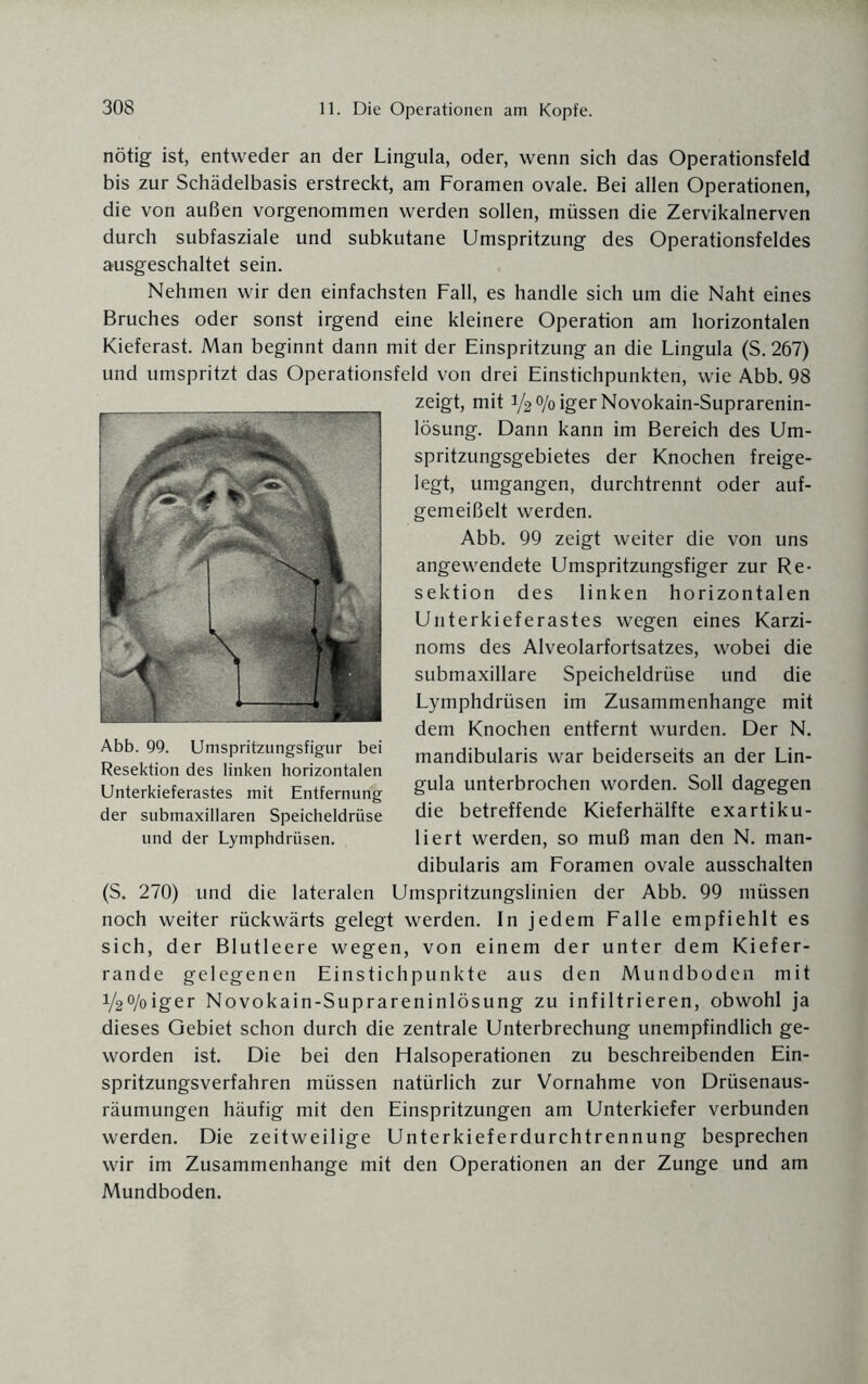 nötig ist, entweder an der Lingula, oder, wenn sich das Operationsfeld bis zur Schädelbasis erstreckt, am Foramen ovale. Bei allen Operationen, die von außen vorgenommen werden sollen, müssen die Zervikalnerven durch subfasziale und subkutane Umspritzung des Operationsfeldes ausgeschaltet sein. Nehmen wir den einfachsten Fall, es handle sich um die Naht eines Bruches oder sonst irgend eine kleinere Operation am horizontalen Kieferast. Man beginnt dann mit der Einspritzung an die Lingula (S. 267) und umspritzt das Operationsfeld von drei Einstichpunkten, wie Abb. 98 zeigt, mit i/styoigerNovokain-Suprarenin- lösung. Dann kann im Bereich des Um¬ spritzungsgebietes der Knochen freige¬ legt, umgangen, durchtrennt oder auf¬ gemeißelt werden. Abb. 99 zeigt weiter die von uns angewendete Umspritzungsfiger zur Re¬ sektion des linken horizontalen Unterkieferastes wegen eines Karzi¬ noms des Alveolarfortsatzes, wobei die submaxillare Speicheldrüse und die Lymphdrüsen im Zusammenhänge mit dem Knochen entfernt wurden. Der N. mandibularis war beiderseits an der Lin¬ gula unterbrochen worden. Soll dagegen die betreffende Kieferhälfte exartiku¬ liert werden, so muß man den N. man¬ dibularis am Foramen ovale ausschalten (S. 270) und die lateralen Umspritzungslinien der Abb. 99 müssen noch weiter rückwärts gelegt werden. In jedem Falle empfiehlt es sich, der Blutleere wegen, von einem der unter dem Kiefer¬ rande gelegenen Einstichpunkte aus den Mundboden mit V2%iger Novokain-Suprareninlösung zu infiltrieren, obwohl ja dieses Gebiet schon durch die zentrale Unterbrechung unempfindlich ge¬ worden ist. Die bei den Halsoperationen zu beschreibenden Ein¬ spritzungsverfahren müssen natürlich zur Vornahme von Drüsenaus¬ räumungen häufig mit den Einspritzungen am Unterkiefer verbunden werden. Die zeitweilige Unterkieferdurchtrennung besprechen wir im Zusammenhänge mit den Operationen an der Zunge und am Mundboden. Abb. 99. Umspritzungsfigur bei Resektion des linken horizontalen Unterkieferastes mit Entfernung der submaxillaren Speicheldrüse und der Lymphdrüsen.