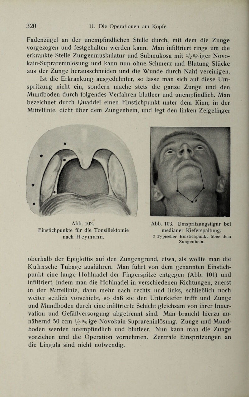 Fadenzügel an der unempfindlichen Stelle durch, mit dem die Zunge vorgezogen und festgehalten werden kann. Man infiltriert rings um die erkrankte Stelle Zungenmuskulatur und Submukosa mit i^/oiger Novo- kain-Suprareninlösung und kann nun ohne Schmerz und Blutung Stücke aus der Zunge herausschneiden und die Wunde durch Naht vereinigen. Ist die Erkrankung ausgedehnter, so lasse man sich auf diese Um¬ spritzung nicht ein, sondern mache stets die ganze Zunge und den Mundboden durch folgendes Verfahren blutleer und unempfindlich. Man bezeichnet durch Quaddel einen Einstichpunkt unter dem Kinn, in der Mittellinie, dicht über dem Zungenbein, und legt den linken Zeigefinger Abb. 102. Einstichpunkte für die Tonsillektomie nach Heymann. Abb. 103. Umspritzungsfigur bei medianer Kieferspaltung. 3 Typischer Einstichpunkt über dem Zungenbein. oberhalb der Epiglottis auf den Zungengrund, etwa, als wollte man die Kuhnsche Tubage ausführen. Man führt von dem genannten Einstich¬ punkt eine lange Hohlnadel der Fingerspitze entgegen (Abb. 101) und infiltriert, indem man die Hohlnadel in verschiedenen Richtungen, zuerst in der Mittellinie, dann mehr nach rechts und links, schließlich noch weiter seitlich vorschiebt, so daß sie den Unterkiefer trifft und Zunge und Mundboden durch eine infiltrierte Schicht gleichsam von ihrer Inner¬ vation und Gefäßversorgung abgetrennt sind. Man braucht hierzu an¬ nähernd 50 ccm y2°/oige Novokain-Suprareninlösung. Zunge und Mund¬ boden werden unempfindlich und blutleer. Nun kann man die Zunge vorziehen und die Operation vornehmen. Zentrale Einspritzungen an die Lingula sind nicht notwendig.
