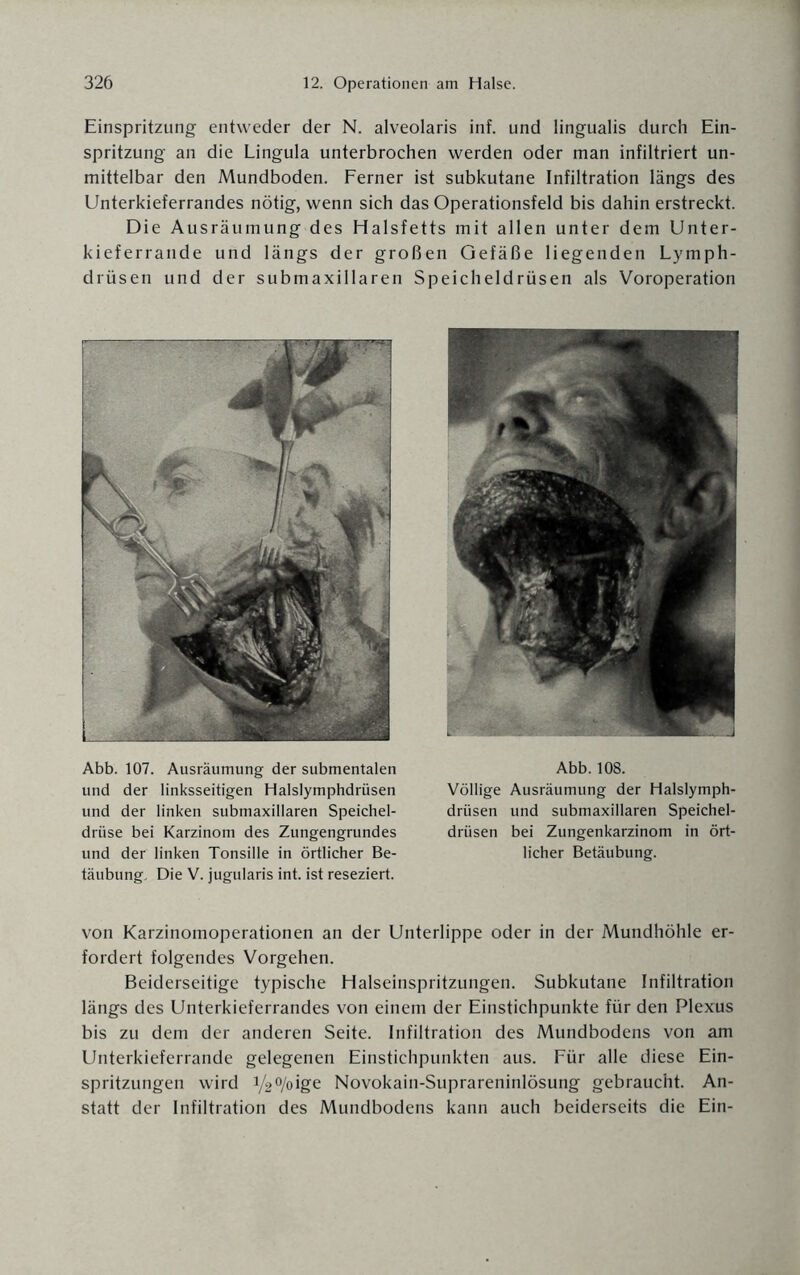 Einspritzung entweder der N. alveolaris inf. und lingualis durch Ein¬ spritzung an die Lingula unterbrochen werden oder man infiltriert un¬ mittelbar den Mundboden. Ferner ist subkutane Infiltration längs des Unterkieferrandes nötig, wenn sich das Operationsfeld bis dahin erstreckt. Die Ausräumung des Halsfetts mit allen unter dem Unter¬ kieferrande und längs der großen Gefäße liegenden Lymph- drüsen und der submaxillaren Speicheldrüsen als Voroperation Abb. 107. Ausräumung der submentalen und der linksseitigen Halslymphdrüsen und der linken submaxillaren Speichel¬ drüse bei Karzinom des Zungengrundes und der linken Tonsille in örtlicher Be¬ täubung. Die V. jugularis int. ist reseziert. Abb. 108. Völlige Ausräumung der Halslymph¬ drüsen und submaxillaren Speichel¬ drüsen bei Zungenkarzinom in ört¬ licher Betäubung. von Karzinomoperationen an der Unterlippe oder in der Mundhöhle er¬ fordert folgendes Vorgehen. Beiderseitige typische Halseinspritzungen. Subkutane Infiltration längs des Unterkieferrandes von einem der Einstichpunkte für den Plexus bis zu dem der anderen Seite. Infiltration des Mundbodens von am Unterkieferrande gelegenen Einstichpunkten aus. Für alle diese Ein¬ spritzungen wird y2°/oige Novokain-Suprareninlösung gebraucht. An¬ statt der Infiltration des Mundbodens kann auch beiderseits die Ein-