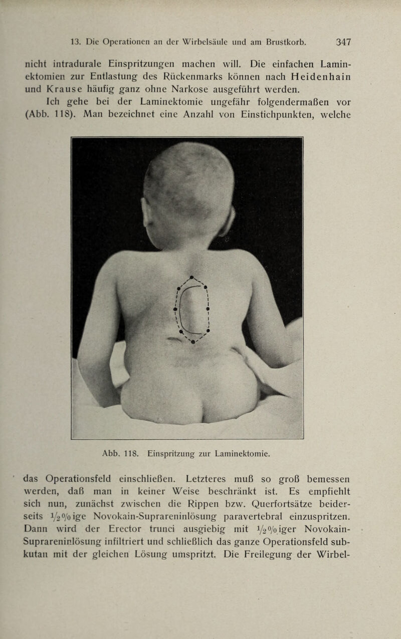 nicht intradurale Einspritzungen machen will. Die einfachen Lamin- ektomien zur Entlastung des Rückenmarks können nach Heidenhain und Krause häufig ganz ohne Narkose ausgeführt werden. Ich gehe bei der Laminektomie ungefähr folgendermaßen vor (Abb. 118). Man bezeichnet eine Anzahl von Einstichpunkten, welche Abb. 118. Einspritzung zur Laminektomie. das Operationsfeld einschließen. Letzteres muß so groß bemessen werden, daß man in keiner Weise beschränkt ist. Es empfiehlt sich nun, zunächst zwischen die Rippen bzw. Querfortsätze beider¬ seits V20/oige Novokain-Suprareninlösung paravertebral einzuspritzen. Dann wird der Erector trunci ausgiebig mit 1/2°/oiger Novokain- Suprareninlösung infiltriert und schließlich das ganze Operationsfeld sub¬ kutan mit der gleichen Lösung umspritzt. Die Freilegung der Wirbel-