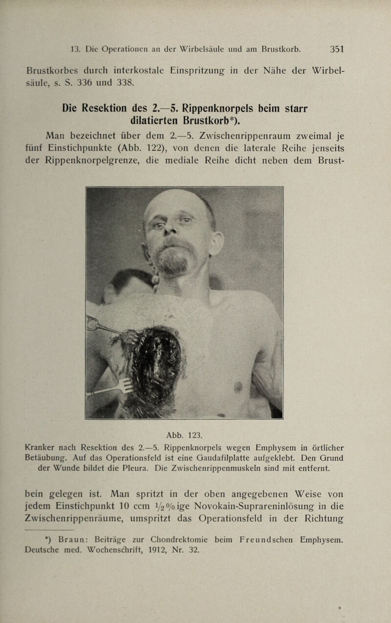 Brustkorbes durch interkostale Einspritzung in der Nähe der Wirbel¬ säule, s. S. 336 und 338. Die Resektion des 2.-5. Rippenknorpels beim starr dilatierten Brustkorb*). Man bezeichnet über dem 2.—5. Zwischenrippenraum zweimal je fünf Einstichpunkte (Abb. 122), von denen die laterale Reihe jenseits der Rippenknorpelgrenze, die mediale Reihe dicht neben dem Brust- Abb. 123. Kranker nach Resektion des 2.—5. Rippenknorpels wegen Emphysem in örtlicher Betäubung. Auf das Operationsfeld ist eine Gaudafilplatte aufgeklebt. Den Grund der Wunde bildet die Pleura. Die Zwischenrippenmuskeln sind mit entfernt. bein gelegen ist. Man spritzt in der oben angegebenen Weise von jedem Einstichpunkt 10 ccm V2 °/o ige Novokain-Suprareninlösung in die Zwischenrippenräume, umspritzt das Operationsfeld in der Richtung *) Braun: Beiträge zur Chondrektomie beim Freund sehen Emphysem. Deutsche med. Wochenschrift, 1912, Nr. 32.