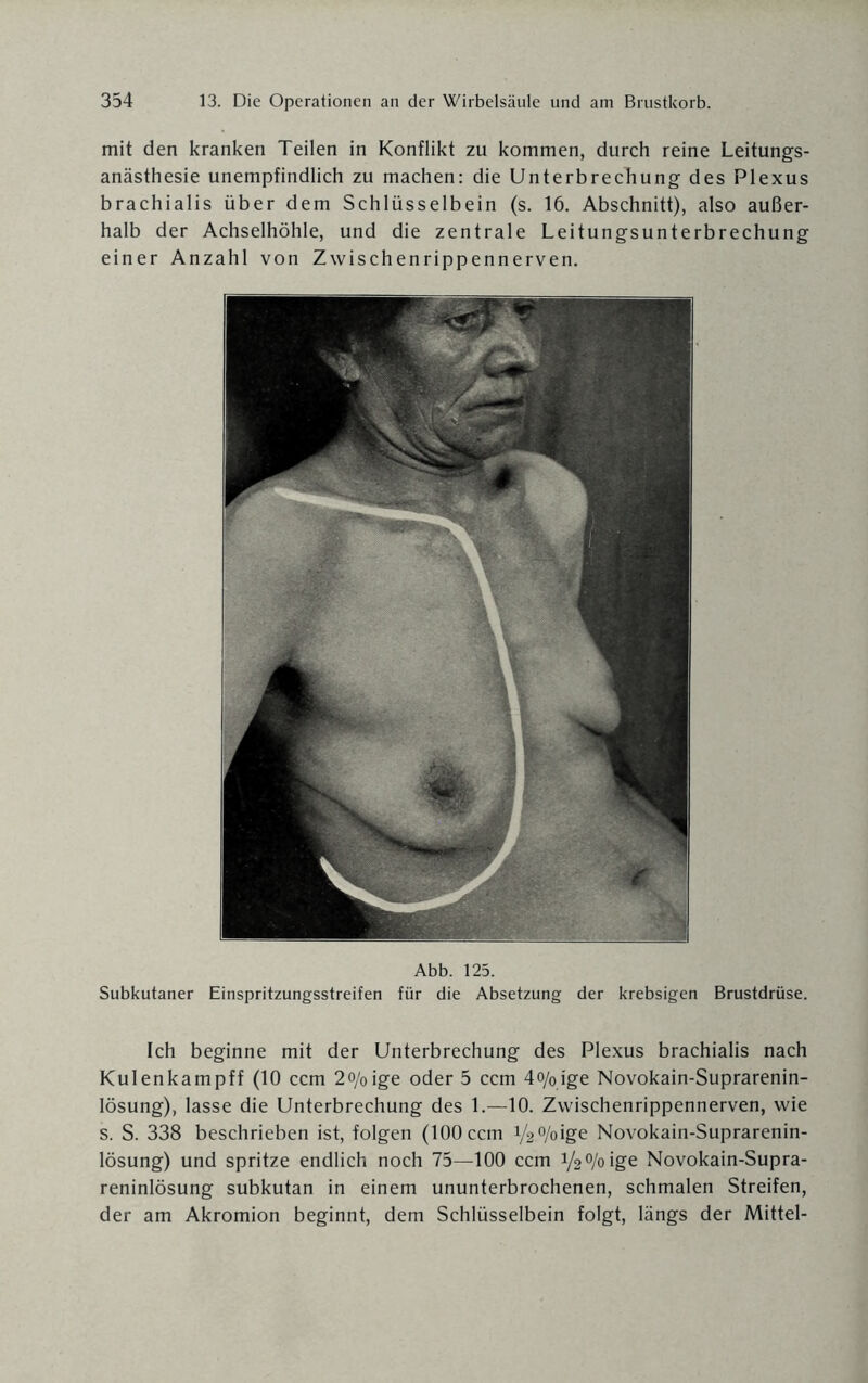 mit den kranken Teilen in Konflikt zu kommen, durch reine Leitungs¬ anästhesie unempfindlich zu machen: die UnterbrecTiung des Plexus brachialis über dem Schlüsselbein (s. 16. Abschnitt), also außer¬ halb der Achselhöhle, und die zentrale Leitungsunterbrechung einer Anzahl von Zwischenrippennerven. Abb. 125. Subkutaner Einspritzungsstreifen für die Absetzung der krebsigen Brustdrüse. Ich beginne mit der Unterbrechung des Plexus brachialis nach Kulenkampff (10 ccm 2o/0ige oder 5 ccm 4o/0ige Novokain-Suprarenin- Iösung), lasse die Unterbrechung des 1.—10. Zwischenrippennerven, wie s. S. 338 beschrieben ist, folgen (100 ccm V2°/oige Novokain-Suprarenin- lösung) und spritze endlich noch 75—100 ccm 1/2%ige Novokain-Supra- reninlösung subkutan in einem ununterbrochenen, schmalen Streifen, der am Akromion beginnt, dem Schlüsselbein folgt, längs der Mittel-