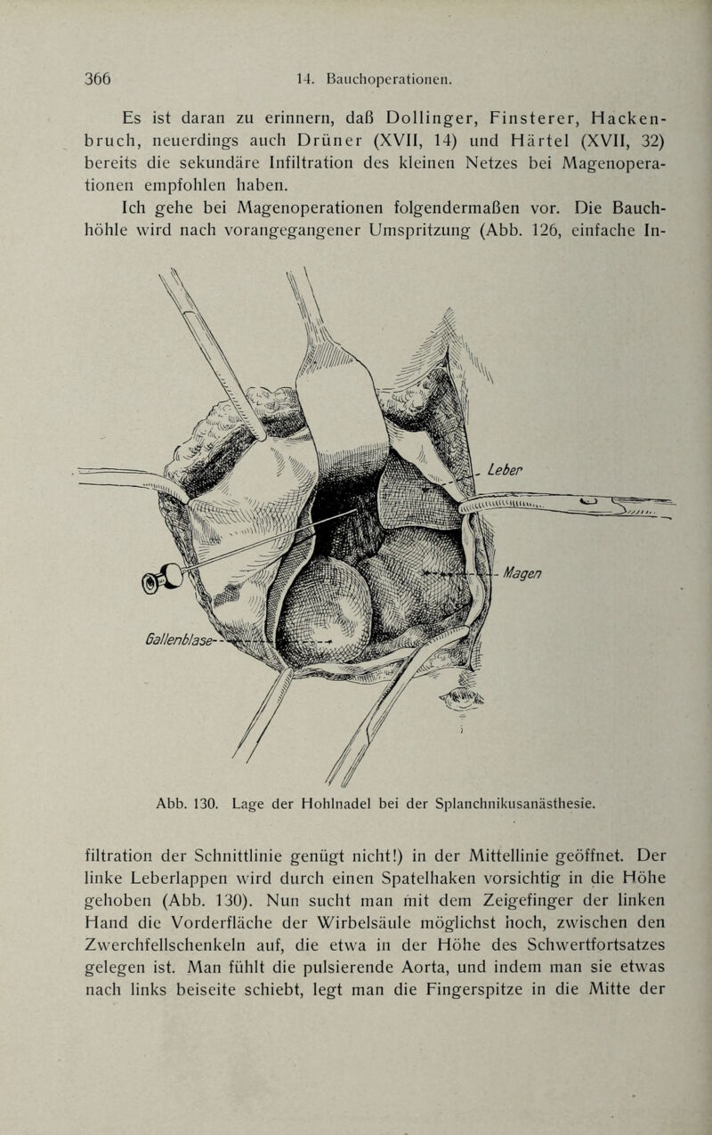 Es ist daran zu erinnern, daß Dollinger, Finsterer, Hacken¬ bruch, neuerdings auch Drüner (XVII, 14) und Härtel (XVII, 32) bereits die sekundäre Infiltration des kleinen Netzes bei Magenopera¬ tionen empfohlen haben. Ich gehe bei Magenoperationen folgendermaßen vor. Die Bauch¬ höhle wird nach vorangegangener Umspritzung (Abb. 126, einfache In- Abb. 130. Lage der Hohlnadel bei der Splanchnikusanästhesie. filtration der Schnittlinie genügt nicht!) in der Mittellinie geöffnet. Der linke Leberlappen wird durch einen Spatelhaken vorsichtig in die Höhe gehoben (Abb. 130). Nun sucht man mit dem Zeigefinger der linken Hand die Vorderfläche der Wirbelsäule möglichst hoch, zwischen den Zwerchfellschenkeln auf, die etwa in der Höhe des Schwertfortsatzes gelegen ist. Man fühlt die pulsierende Aorta, und indem man sie etwas nach links beiseite schiebt, legt man die Fingerspitze in die Mitte der