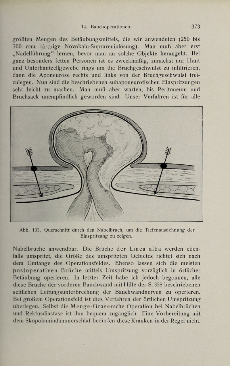 größten Mengen des Betäubungsmittels, die wir anwendeten (250 bis 300 ccm 1/20/0 ige Novokain-Suprareninlösung). Man muß aber erst „Nadelführung“ lernen, bevor man an solche Objekte herangeht. Bei ganz besonders fetten Personen ist es zweckmäßig, zunächst nur Haut und Unterhautzellgewebe rings um die Bruchgeschwulst zu infiltrieren, dann die Aponeurose rechts und links von der Bruchgeschwulst frei¬ zulegen. Nun sind die beschriebenen subaponeurotischen Einspritzungen sehr leicht zu machen. Man muß aber warten, bis Peritoneum und Bruchsack unempfindlich geworden sind. Unser Verfahren ist für alle Abb. 133. Querschnitt durch den Nabelbruch, um die Tiefenausdehnung der Einspritzung zu zeigen. Nabelbrüche anwendbar. Die Brüche der Linea alba werden eben¬ falls umspritzt, die Größe des umspritzten Gebietes richtet sich nach dem Umfange des Operationsfeldes. Ebenso lassen sich die meisten postoperativen Brüche mittels Umspritzung vorzüglich in örtlicher Betäubung operieren. In letzter Zeit habe ich jedoch begonnen, alle diese Brüche der vorderen Bauchwand mit Hilfe der S. 358 beschriebenen seitlichen Leitungsunterbrechung der Bauchwandnerven zu operieren. Bei großem Operationsfeld ist dies Verfahren der örtlichen Umspritzung überlegen. Selbst die Menge-Grasersche Operation bei Nabelbrüchen und Rektusdiastase ist ihm bequem zugänglich. Eine Vorbereitung mit dem Skopolamindämmerschlaf bedürfen diese Kranken in der Regel nicht.