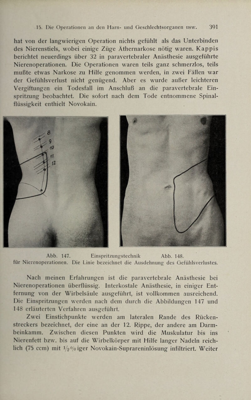 hat von der langwierigen Operation nichts gefühlt als das Unterbinden des Nierenstiels, wobei einige Züge Äthernarkose nötig waren. Käppis berichtet neuerdings über 32 in paravertebraler Anästhesie ausgeführte Nierenoperationen. Die Operationen waren teils ganz schmerzlos, teils mußte etwas Narkose zu Hilfe genommen werden, in zwei Fällen war der Gefühlsverlust nicht genügend. Aber es wurde außer leichteren Vergiftungen ein Todesfall im Anschluß an die paravertebrale Ein¬ spritzung beobachtet. Die sofort nach dem Tode entnommene Spinal¬ flüssigkeit enthielt Novokain. Nach meinen Erfahrungen ist die paravertebrale Anästhesie bei Nierenoperationen überflüssig. Interkostale Anästhesie, in einiger Ent¬ fernung von der Wirbelsäule ausgeführt, ist vollkommen ausreichend. Die Einspritzungen werden nach dem durch die Abbildungen 147 und 148 erläuterten Verfahren ausgeführt. Zw'ei Einstichpunkte werden am lateralen Rande des Rücken¬ streckers bezeichnet, der eine an der 12. Rippe, der andere am Darm¬ beinkamm. Zwischen diesen Punkten wird die Muskulatur bis ins Nierenfett bzw. bis auf die Wirbelkörper mit Hilfe langer Nadeln reich¬ lich (75 ccm) mit 12°/oiger Novokain-Suprareninlösung infiltriert. Weiter