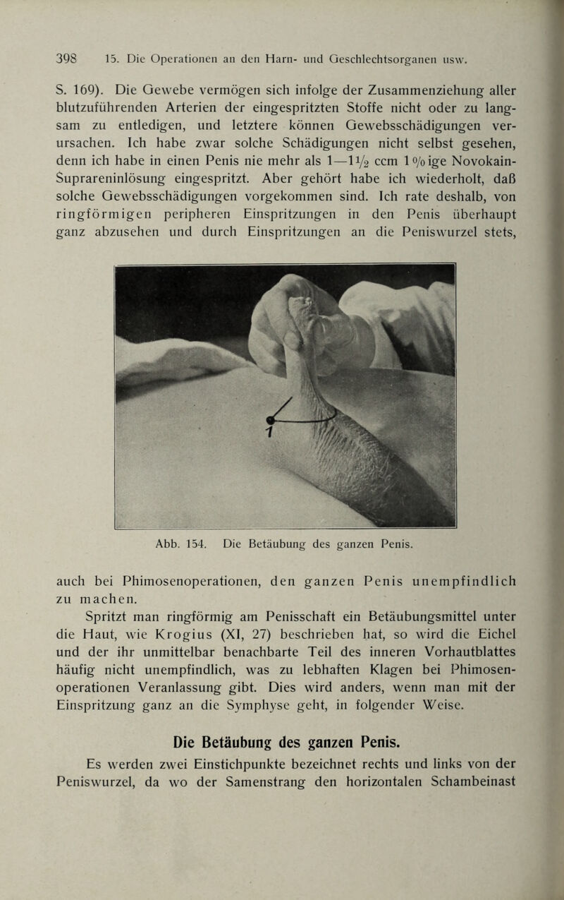 S. 169). Die Gewebe vermögen sich infolge der Zusammenziehung aller blutzuführenden Arterien der eingespritzten Stoffe nicht oder zu lang¬ sam zu entledigen, und letztere können Gewebsschädigungen ver¬ ursachen. Ich habe zwar solche Schädigungen nicht selbst gesehen, denn ich habe in einen Penis nie mehr als 1—11/2 ccm lo/oige Novokain- Suprareninlösung eingespritzt. Aber gehört habe ich wiederholt, daß solche Gewebsschädigungen vorgekommen sind. Ich rate deshalb, von ringförmigen peripheren Einspritzungen in den Penis überhaupt ganz abzusehen und durch Einspritzungen an die Peniswurzel stets, Abb. 154. Die Betäubung des ganzen Penis. auch bei Phimosenoperationen, den ganzen Penis unempfindlich zu machen. Spritzt man ringförmig am Penisschaft ein Betäubungsmittel unter die Haut, wie Krogius (XI, 27) beschrieben hat, so wird die Eichel und der ihr unmittelbar benachbarte Teil des inneren Vorhautblattes häufig nicht unempfindlich, was zu lebhaften Klagen bei Phimosen¬ operationen Veranlassung gibt. Dies wird anders, wenn man mit der Einspritzung ganz an die Symphyse geht, in folgender Weise. Die Betäubung des ganzen Penis. Es werden zwei Einstichpunkte bezeichnet rechts und links von der Peniswurzel, da wo der Samenstrang den horizontalen Schambeinast