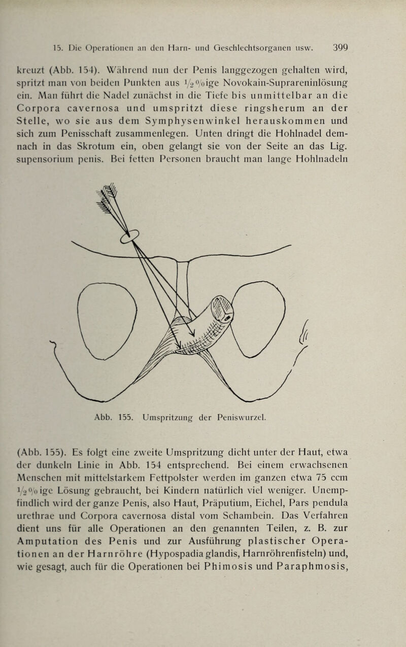 kreuzt (Abb. 154). Während nun der Penis langgezogen gehalten wird, spritzt man von beiden Punkten aus V2 %igfe Novokain-Suprareninlösung ein. Man führt die Nadel zunächst in die Tiefe bis unmittelbar an die Corpora cavernosa und umspritzt diese ringsherum an der Stelle, wo sie aus dem Symphysenwinkel herauskommen und sich zum Penisschaft Zusammenlegen. Unten dringt die Hohlnadel dem¬ nach in das Skrotum ein, oben gelangt sie von der Seite an das Lig. supensorium penis. Bei fetten Personen braucht man lange Hohlnadeln Abb. 155. Umspritzung der Peniswurzel. (Abb. 155). Es folgt eine zweite Umspritzung dicht unter der Haut, etwa der dunkeln Linie in Abb. 154 entsprechend. Bei einem erwachsenen Menschen mit mittelstarkem Fettpolster werden im ganzen etwa 75 ccm 1/2°/o ige Lösung gebraucht, bei Kindern natürlich viel weniger. Unemp¬ findlich wird der ganze Penis, also Haut, Präputium, Eichel, Pars pendula urethrae und Corpora cavernosa distal vom Schambein. Das Verfahren dient uns für alle Operationen an den genannten Teilen, z. B. zur Amputation des Penis und zur Ausführung plastischer Opera¬ tionen an der Harnröhre (Hypospadiaglandis, Harnröhrenfisteln) und, wie gesagt, auch für die Operationen bei Phimosis und Paraphmosis,