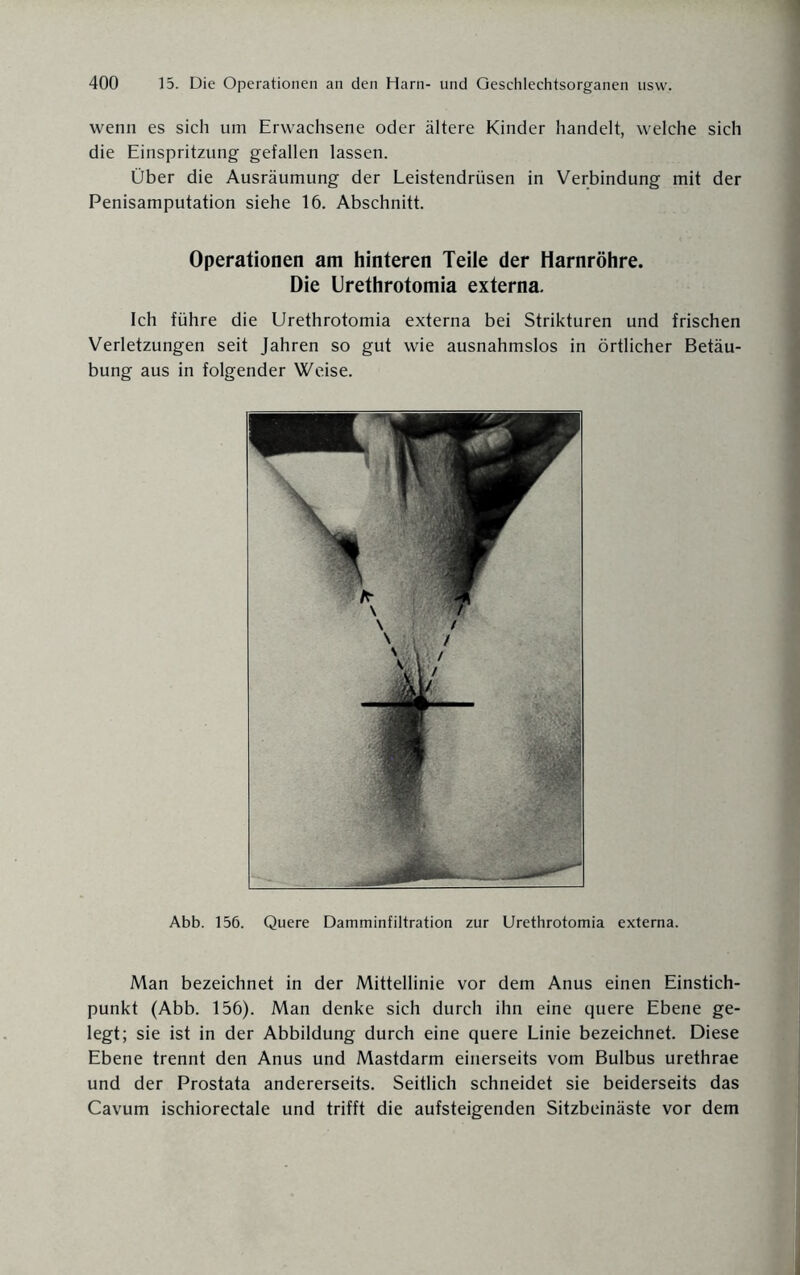 wenn es sich um Erwachsene oder ältere Kinder handelt, welche sich die Einspritzung gefallen lassen. Über die Ausräumung der Leistendrüsen in Verbindung mit der Penisamputation siehe 16. Abschnitt. Operationen am hinteren Teile der Harnröhre. Die Urethrotomia externa. Ich führe die Urethrotomia externa bei Strikturen und frischen Verletzungen seit Jahren so gut wie ausnahmslos in örtlicher Betäu¬ bung aus in folgender Weise. Abb. 156. Quere Damminfiltration zur Urethrotomia externa. Man bezeichnet in der Mittellinie vor dem Anus einen Einstich¬ punkt (Abb. 156). Man denke sich durch ihn eine quere Ebene ge¬ legt; sie ist in der Abbildung durch eine quere Linie bezeichnet. Diese Ebene trennt den Anus und Mastdarm einerseits vom Bulbus urethrae und der Prostata andererseits. Seitlich schneidet sie beiderseits das Cavum ischiorectale und trifft die aufsteigenden Sitzbeinäste vor dem