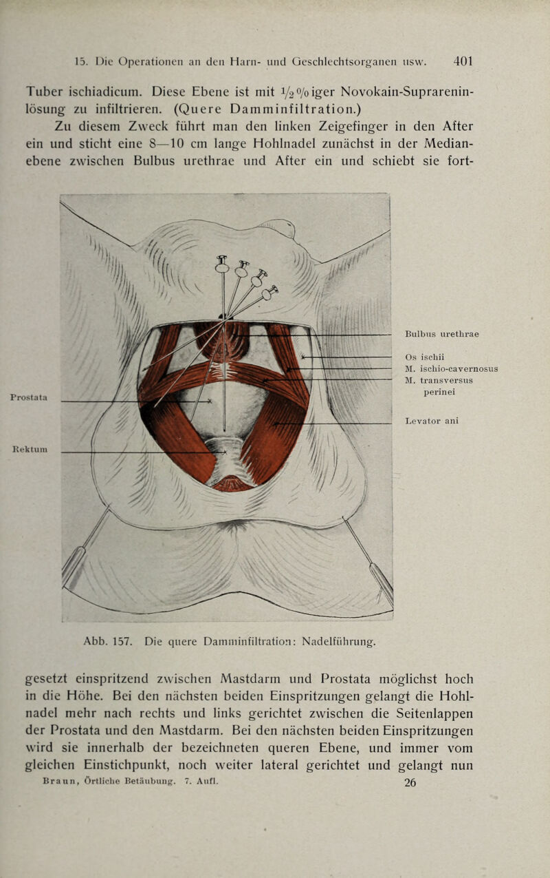 Tuber ischiadicum. Diese Ebene ist mit V20/oiger Novokain-Suprarenin- lösung zu infiltrieren. (Quere Damminfiltration.) Zu diesem Zweck führt man den linken Zeigefinger in den After ein und sticht eine 8—10 cm lange Hohlnadel zunächst in der Median¬ ebene zwischen Bulbus urethrae und After ein und schiebt sie fort- Prostata Rektum Bulbus urethrae Os ischii M. ischio-cavernosus M. transversus perinei Levator ani Abb. 157. Die quere Damminfiltration: Nadelfiihrung. gesetzt einspritzend zwischen Mastdarm und Prostata möglichst hoch in die Höhe. Bei den nächsten beiden Einspritzungen gelangt die Hohl¬ nadel mehr nach rechts und links gerichtet zwischen die Seitenlappen der Prostata und den Mastdarm. Bei den nächsten beiden Einspritzungen wird sie innerhalb der bezeichneten queren Ebene, und immer vom gleichen Einstichpunkt, noch weiter lateral gerichtet und gelangt nun Braun, örtliche Betäubung. 7. Aufl. 26