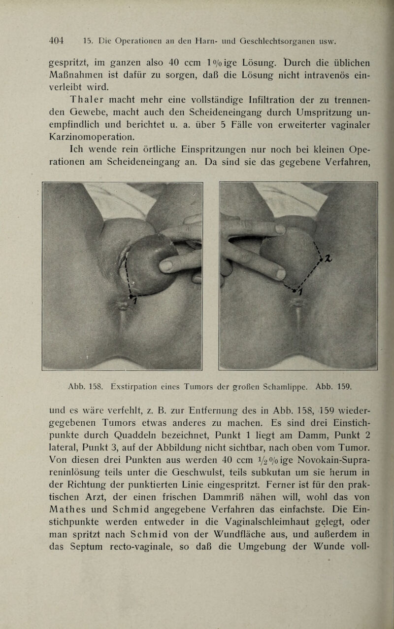 gespritzt, im ganzen also 40 ccm lo/oige Lösung. t)urch die üblichen Maßnahmen ist dafür zu sorgen, daß die Lösung nicht intravenös ein¬ verleibt wird. Thal er macht mehr eine vollständige Infiltration der zu trennen¬ den Gewebe, macht auch den Scheideneingang durch Umspritzung un¬ empfindlich und berichtet u. a. über 5 Fälle von erweiterter vaginaler Karzinomoperation. Ich wende rein örtliche Einspritzungen nur noch bei kleinen Ope- rationen am Scheideneingang an. Da sind sie das gegebene Verfahren, ^ i U ' ■ i , /,  oB \ 7{ r . >V >X \ V-—^ ' jsL S* . , .4 Abb. 158. Exstirpation eines Tumors der großen Schamlippe. Abb. 159. und es wäre verfehlt, z. B. zur Entfernung des in Abb. 158, 159 wieder¬ gegebenen Tumors etwas anderes zu machen. Es sind drei Einstich¬ punkte durch Quaddeln bezeichnet, Punkt 1 liegt am Damm, Punkt 2 lateral, Punkt 3, auf der Abbildung nicht sichtbar, nach oben vom Tumor. Von diesen drei Punkten aus werden 40 ccm y2°/oige Novokain-Supra- reninlösung teils unter die Geschwulst, teils subkutan um sie herum in der Richtung der punktierten Linie eingespritzt. Ferner ist für den prak¬ tischen Arzt, der einen frischen Dammriß nähen will, wohl das von Mathes und Schmid angegebene Verfahren das einfachste. Die Ein¬ stichpunkte werden entweder in die Vaginalschleimhaut gelegt, oder man spritzt nach Schmid von der Wundfläche aus, und außerdem in das Septum recto-vaginale, so daß die Umgebung der Wunde voll-