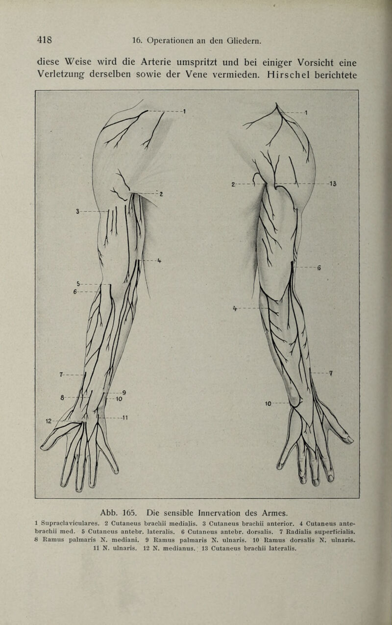diese Weise wird die Arterie umspritzt und bei einiger Vorsicht eine Verletzung derselben sowie der Vene vermieden. Hirschei berichtete Abb. 165. Die sensible Innervation des Armes. 1 Supraclaviculares. 2 Cutaneus brachii mediajis. 3 Cutaneus brachii anterior. 4 Cutaneus ante- braehii med. 5 Cutaneus antebr. lateralis. 6 Cutaneus antebr. dorsalis. 7 Radialis superficialis. 8 Ramus palmaris N. mediani. 9 Ramus palmaris N. ulnaris. 10 Ramus dorsalis N. ulnaris. 11 N. ulnaris. 12 N. medianus. 13 Cutaneus brachii lateralis.