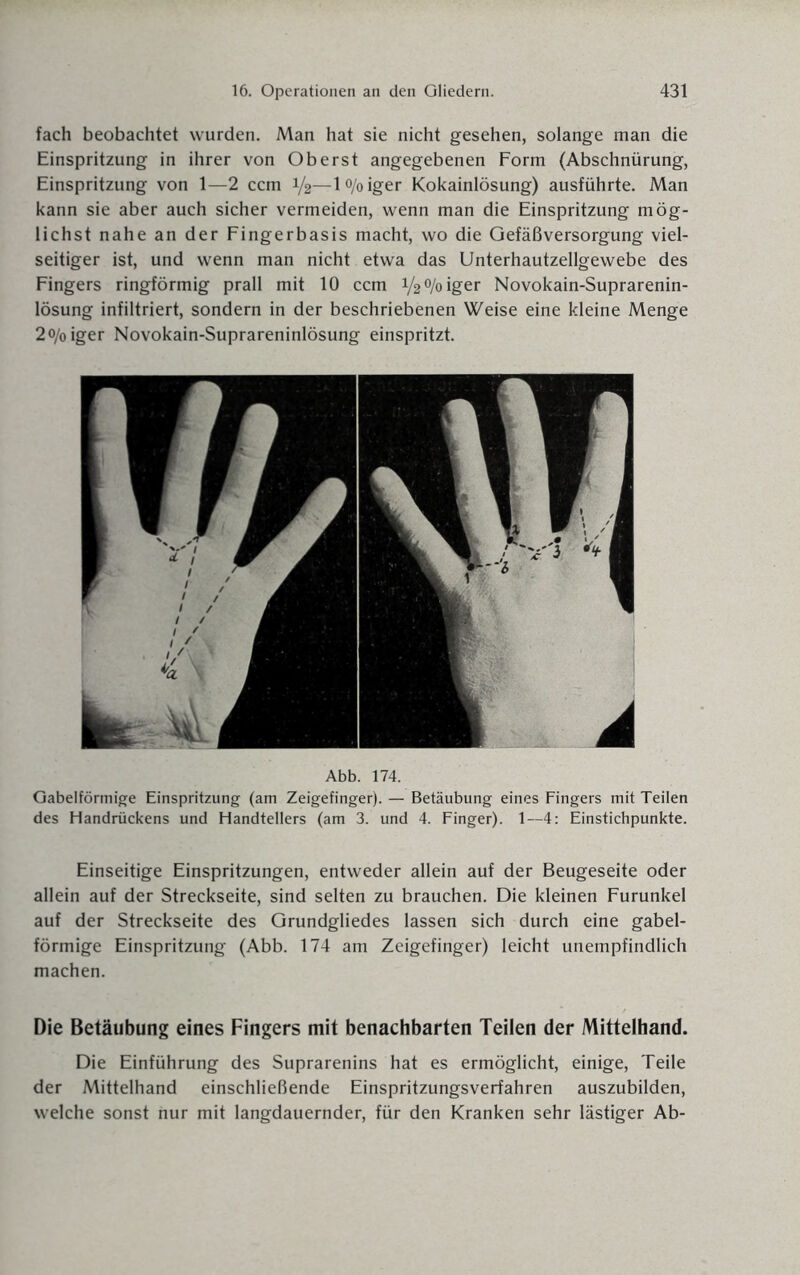 fach beobachtet wurden. Man hat sie nicht gesehen, solange man die Einspritzung in ihrer von Oberst angegebenen Form (Abschnürung, Einspritzung von 1—2 ccm 1/2—l°/oiger Kokainlösung) ausführte. Man kann sie aber auch sicher vermeiden, wenn man die Einspritzung mög¬ lichst nahe an der Fingerbasis macht, wo die Gefäßversorgung viel¬ seitiger ist, und wenn man nicht etwa das Unterhautzellgewebe des Fingers ringförmig prall mit 10 ccm V^/oiger Novokain-Suprarenin- lösung infiltriert, sondern in der beschriebenen Weise eine kleine Menge 2o/oiger Novokain-Suprareninlösung einspritzt. Abb. 174. Gabelförmige Einspritzung (am Zeigefinger). — Betäubung eines Fingers mit Teilen des Handrückens und Handtellers (am 3. und 4. Finger). 1—4: Einstichpunkte. Einseitige Einspritzungen, entweder allein auf der Beugeseite oder allein auf der Streckseite, sind selten zu brauchen. Die kleinen Furunkel auf der Streckseite des Grundgliedes lassen sich durch eine gabel¬ förmige Einspritzung (Abb. 174 am Zeigefinger) leicht unempfindlich machen. Die Betäubung eines Fingers mit benachbarten Teilen der Mittelhand. Die Einführung des Suprarenins hat es ermöglicht, einige, Teile der Mittelhand einschließende Einspritzungsverfahren auszubilden, welche sonst nur mit langdauernder, für den Kranken sehr lästiger Ab-
