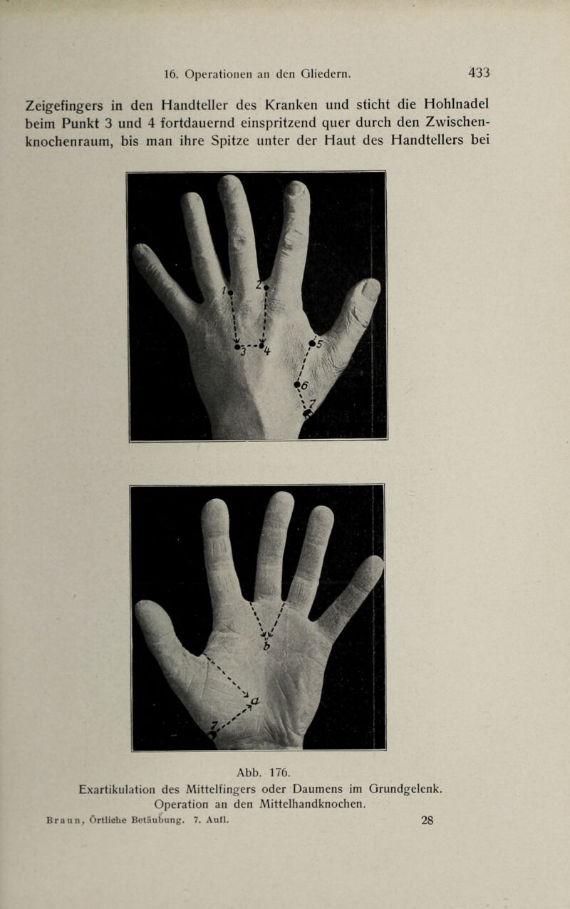 Zeigefingers in den Handteller des Kranken und sticht die Hohlnadel beim Punkt 3 und 4 fortdauernd einspritzend quer durch den Zwischen¬ knochenraum, bis man ihre Spitze unter der Haut des Handtellers bei Abb. 176. Exartikulation des Mittelfingers oder Daumens im Grundgelenk. Operation an den Mittelhandknochen. Braun, Örtliche Betäubung. 7. Aull. 28
