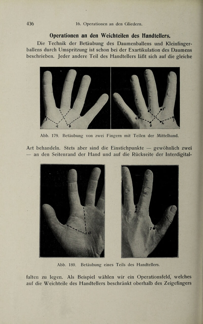 Operationen an den Weichteilen des Handtellers. Die Technik der Betäubung des Daumenballens und Kleinfinger¬ ballens durch Umspritzung ist schon bei der Exartikulation des Daumens beschrieben. Jeder andere Teil des Handtellers läßt sich auf die gleiche Abb. 179. Betäubung von zwei Fingern mit Teilen der Mittelhand. Art behandeln. Stets aber sind die Einstichpunkte — gewöhnlich zwei — an den Seitenrand der Hand und auf die Rückseite der Interdigital- Abb. 180. Betäubung eines Teils des Handtellers. falten zu legen. Als Beispiel wählen wir ein Operationsfeld, welches auf die Weichteile des Handtellers beschränkt oberhalb des Zeigefingers