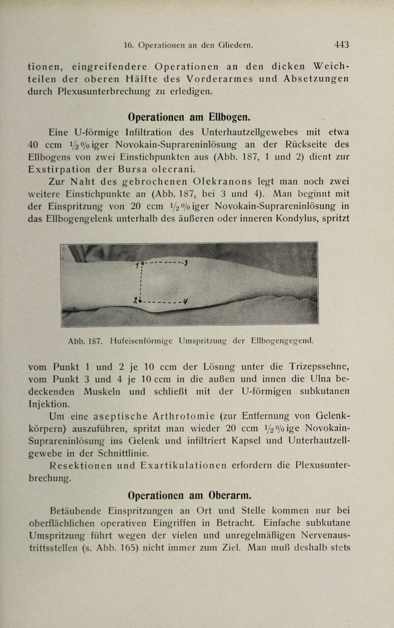 tionen, eingreifendere Operationen an den dicken Weich¬ teilen der oberen Hälfte des Vorderarmes und Absetzungen durch Plexusunterbrechung zu erledigen. Operationen am Ellbogen. Eine U-förmige Infiltration des Unterhautzellgewebes mit etwa 40 ccm 1/2°/oiger Novokain-Suprareninlösung an der Rückseite des Ellbogens von zwei Einstichpunkten aus (Abb. 187, 1 und 2) dient zur Exstirpation der Bursa olecrani. Zur Naht des gebrochenen Olekranons legt man noch zwei weitere Einstichpunkte an (Abb. 187, bei 3 und 4). Man beginnt mit der Einspritzung von 20 ccm V2 °/o iger Novokain-Suprareninlösung in das Ellbogengelenk unterhalb des äußeren oder inneren Kondylus, spritzt Abb. 187. Hufeisenförmige Umspritzung der Ellbogengegend. vom Punkt 1 und 2 je 10 ccm der Lösung unter die Trizepssehne, vom Punkt 3 und 4 je 10 ccm in die außen und innen die Ulna be¬ deckenden Muskeln und schließt mit der U-förmigen subkutanen Injektion. Um eine aseptische Arthrotomie (zur Entfernung von Gelenk¬ körpern) auszuführen, spritzt man wieder 20 ccm V2 °/° ige Novokain- Suprareninlösung ins Gelenk und infiltriert Kapsel und Unterhautzell¬ gewebe in der Schnittlinie. Resektionen und Exartikulationen erfordern die Plexusunter¬ brechung. Operationen am Oberarm. Betäubende Einspritzungen an Ort und Stelle kommen nur bei oberflächlichen operativen Eingriffen in Betracht. Einfache subkutane Umspritzung führt wegen der vielen und unregelmäßigen Nervenaus- trittsstellen (s. Abb. 165) nicht immer zum Ziel. Man muß deshalb stets