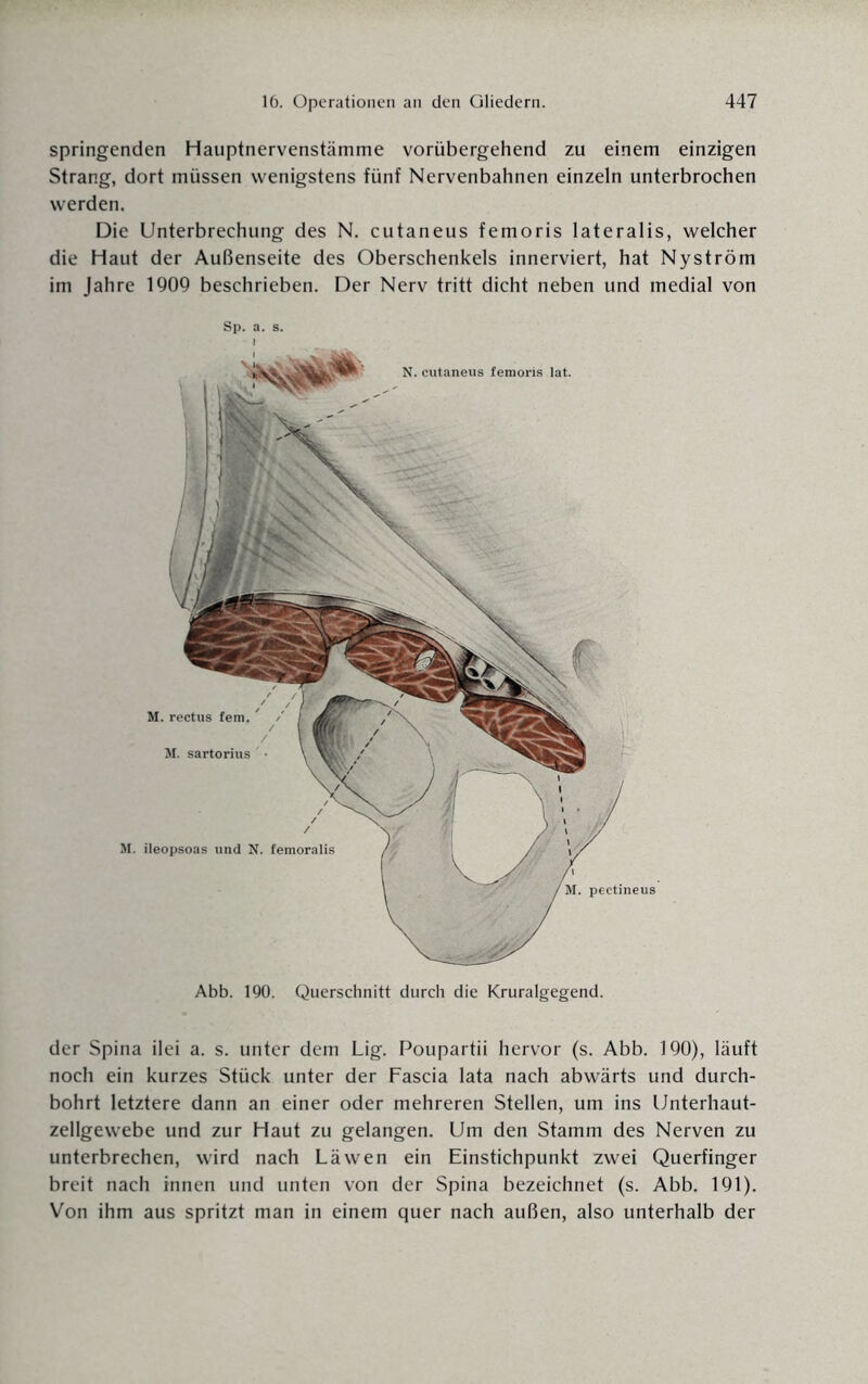 springenden Hauptnervenstämme vorübergehend zu einem einzigen Strang, dort müssen wenigstens fünf Nervenbahnen einzeln unterbrochen werden. Die Unterbrechung des N. cutaneus femoris lateralis, welcher die Haut der Außenseite des Oberschenkels innerviert, hat Nyström im Jahre 1909 beschrieben. Der Nerv tritt dicht neben und medial von Sp. a. s. der Spina ilei a. s. unter dem Lig. Poupartii hervor (s. Abb. 190), läuft noch ein kurzes Stück unter der Fascia lata nach abwärts und durch¬ bohrt letztere dann an einer oder mehreren Stellen, um ins Unterhaut¬ zellgewebe und zur Haut zu gelangen. Um den Stamm des Nerven zu unterbrechen, wird nach Läwen ein Einstichpunkt zwei Querfinger breit nach innen und unten von der Spina bezeichnet (s. Abb. 191). Von ihm aus spritzt man in einem quer nach außen, also unterhalb der