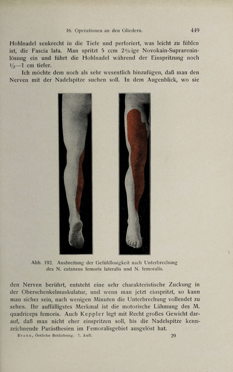 Hohlnadel senkrecht in die Tiefe und perforiert, was leicht zu fühlen ist, die Fascia lata. Man spritzt 5 ccm 2o/0ige Novokain-Suprarenin- lösung ein und führt die Hohlnadel während der Einspritzung noch 1/2—1 cm tiefer. Ich möchte dem noch als sehr wesentlich hinzufügen, daß man den Nerven mit der Nadelspitze suchen soll. In dem Augenblick, wo sie den Nerven berührt, entsteht eine sehr charakteristische Zuckung in der Oberschenkelmuskulatur, und wenn man jetzt einspritzt, so kann man sicher sein, nach wenigen Minuten die Unterbrechung vollendet zu sehen. Ihr auffälligstes Merkmal ist die motorische Lähmung des M. quadriceps femoris. Auch Keppler legt mit Recht großes Gewicht dar¬ auf, daß man nicht eher einspritzen soll, bis die Nadelspitze kenn¬ zeichnende Parästhesien im Femoralisgebiet ausgelöst hat. Braun, Örtliche Betäubung. 7. Aufl. 29