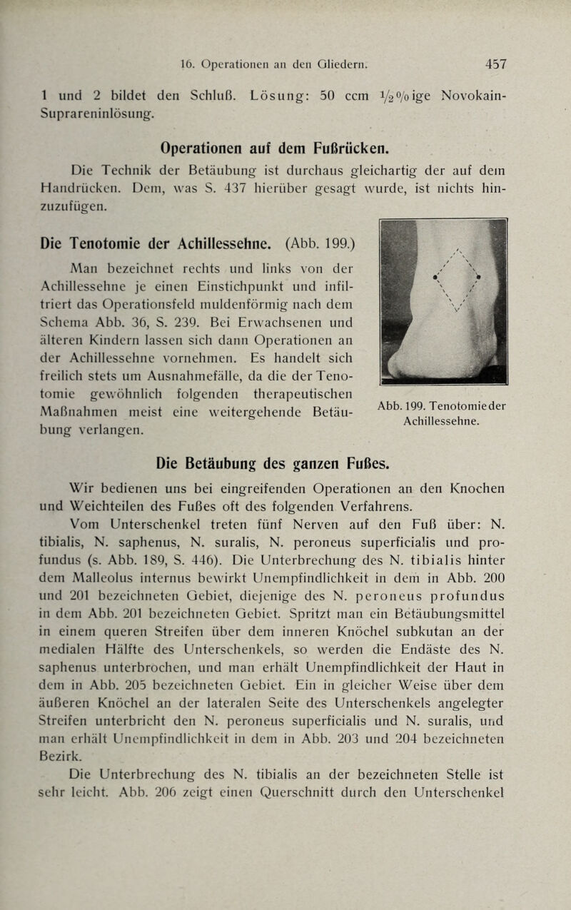 1 und 2 bildet den Schluß. Lösung: 50 ccm Vätyoige Novokain- Suprareninlösung. Operationen auf dem Fußrücken. Die Technik der Betäubung ist durchaus gleichartig der auf dem Handrücken. Dem, was S. 437 hierüber gesagt wurde, ist nichts hin¬ zuzufügen. Die Tenotomie der Achillessehne. (Abb. 199.) Man bezeichnet rechts und links von der Achillessehne je einen Einstichpunkt und infil¬ triert das Operationsfeld muldenförmig nach dem Schema Abb. 36, S. 239. Bei Erwachsenen und älteren Kindern lassen sich dann Operationen an der Achillessehne vornehmen. Es handelt sich freilich stets um Ausnahmefälle, da die der Teno¬ tomie gewöhnlich folgenden therapeutischen Maßnahmen meist eine weitergehende Betäu- Abb. 199. Tenotomie der , , Achillessehne, bung verlangen. Die Betäubung des ganzen Fußes. Wir bedienen uns bei eingreifenden Operationen an den Knochen und Weichteilen des Fußes oft des folgenden Verfahrens. Vom Unterschenkel treten fünf Nerven auf den Fuß über: N. tibialis, N. saphenus, N. suralis, N. peroneus superficialis und pro- fundus (s. Abb. 189, S. 446). Die Unterbrechung des N. tibialis hinter dem Malleolus internus bewirkt Unempfindlichkeit in dem in Abb. 200 und 201 bezeichneten Gebiet, diejenige des N. peroneus profundus in dem Abb. 201 bezeichneten Gebiet. Spritzt man ein Betäubungsmittel in einem queren Streifen über dem inneren Knöchel subkutan an der medialen Hälfte des Unterschenkels, so werden die Endäste des N. saphenus unterbrochen, und man erhält Unempfindlichkeit der Haut in dem in Abb. 205 bezeichneten Gebiet. Ein in gleicher Weise über dem äußeren Knöchel an der lateralen Seite des Unterschenkels angelegter Streifen unterbricht den N. peroneus superficialis und N. suralis, und man erhält Unempfindlichkeit in dem in Abb. 203 und 204 bezeichneten Bezirk. Die Unterbrechung des N. tibialis an der bezeichneten Stelle ist sehr leicht. Abb. 206 zeigt einen Querschnitt durch den Unterschenkel