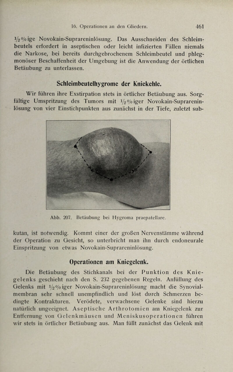 V2°/oige Novokain-Suprareninlösung. Das Ausschneiden des Schleim¬ beutels erfordert in aseptischen oder leicht infizierten Fällen niemals die Narkose, bei bereits durchgebrochenem Schleimbeutel und phleg¬ monöser Beschaffenheit der Umgebung ist die Anwendung der örtlichen Betäubung zu unterlassen. Schleimbeutelhygrome der Kniekehle. Wir führen ihre Exstirpation stets in örtlicher Betäubung aus. Sorg¬ fältige Umspritzung des Tumors mit y20/oiger Novokain-Suprarenin¬ lösung von vier Einstichpunkten aus zunächst in der Tiefe, zuletzt sub- Abb. 207. Betäubung bei Hygroma praepatellare. kutan, ist notwendig. Kommt einer der großen Ne.rvenstämme während der Operation zu Gesicht, so unterbricht man ihn durch endoneurale Einspritzung von etwas Novokain-Suprareninlösung. Operationen am Kniegelenk. Die Betäubung des Stichkanals bei der Punktion des Knie¬ gelenks geschieht nach den S. 232 gegebenen Regeln. Anfüllung des Gelenks mit y2°/oiger Novokain-Suprareninlösung macht die Synovial¬ membran sehr schnell unempfindlich und löst durch Schmerzen be¬ dingte Kontrakturen. Verödete, verwachsene Gelenke sind hierzu natürlich ungeeignet. Aseptische Arthrotomien am Kniegelenk zur Entfernung von Gelenkmäusen und Meniskusoperationen führen wir stets in örtlicher Betäubung aus. Man füllt zunächst das Gelenk mit