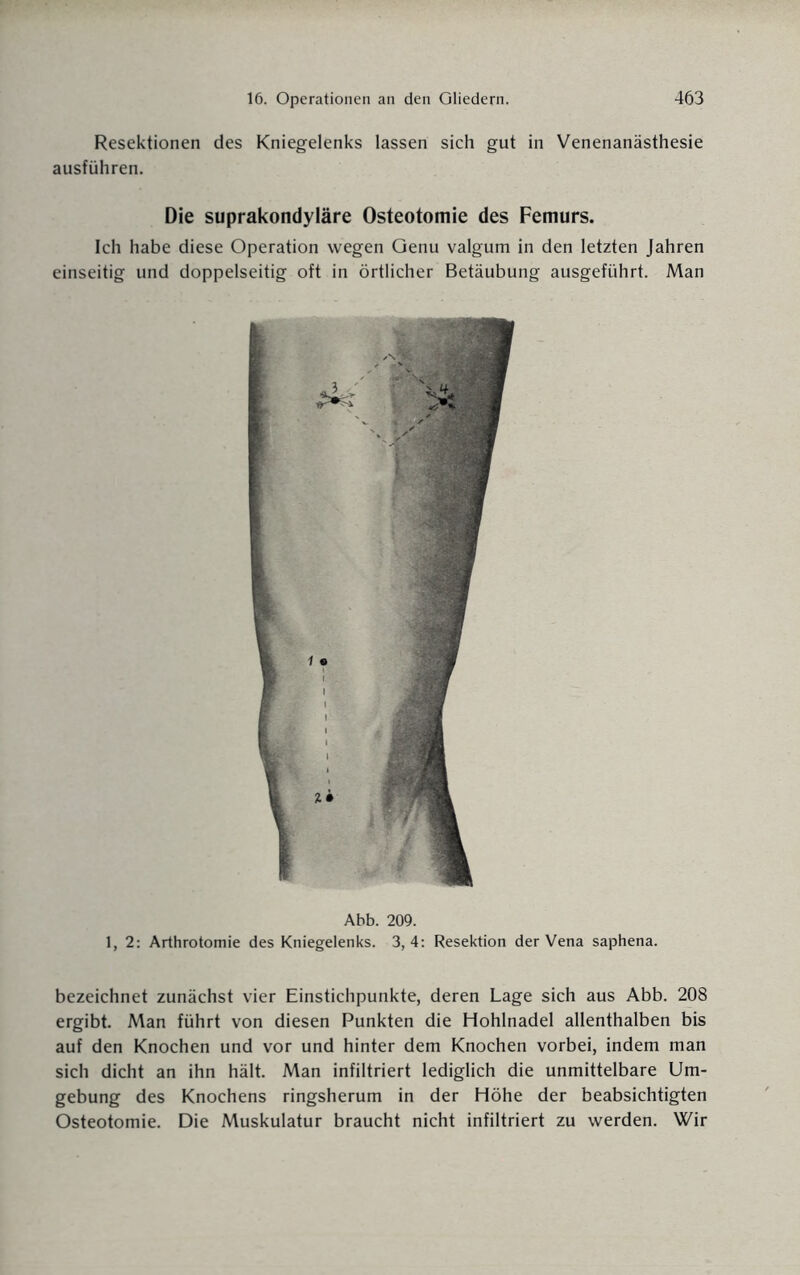 Resektionen des Kniegelenks lassen sich gut in Venenanästhesie ausführen. Die suprakondyläre Osteotomie des Femurs. Ich habe diese Operation wegen Genu valgum in den letzten Jahren einseitig und doppelseitig oft in örtlicher Betäubung ausgeführt. Man Abb. 209. 1, 2: Arthrotomie des Kniegelenks. 3,4: Resektion der Vena saphena. bezeichnet zunächst vier Einstichpunkte, deren Lage sich aus Abb. 208 ergibt. Man führt von diesen Punkten die Hohlnadel allenthalben bis auf den Knochen und vor und hinter dem Knochen vorbei, indem man sich dicht an ihn hält. Man infiltriert lediglich die unmittelbare Um¬ gebung des Knochens ringsherum in der Höhe der beabsichtigten Osteotomie. Die Muskulatur braucht nicht infiltriert zu werden. Wir
