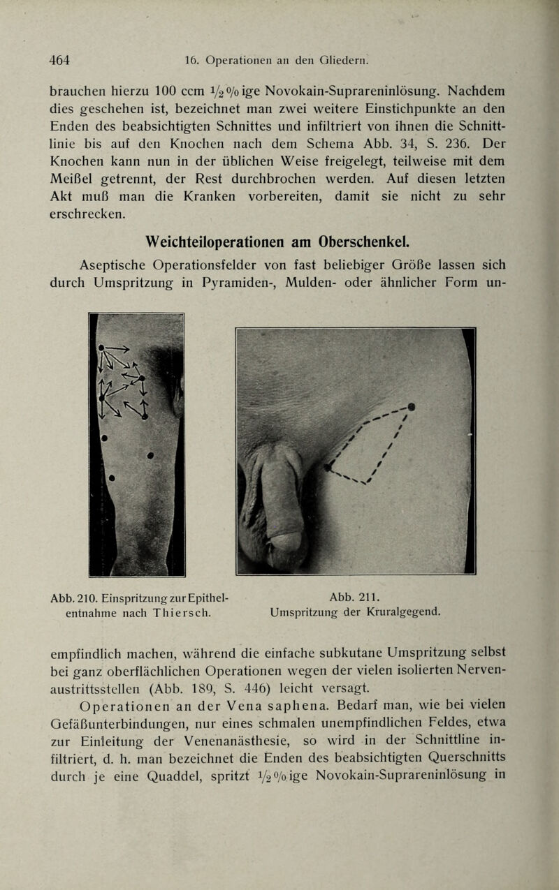 brauchen hierzu 100 ccm i/g'o/oige Novokain-Suprareninlösung. Nachdem dies geschehen ist, bezeichnet man zwei weitere Einstichpunkte an den Enden des beabsichtigten Schnittes und infiltriert von ihnen die Schnitt¬ linie bis auf den Knochen nach dem Schema Abb. 34, S. 236. Der Knochen kann nun in der üblichen Weise freigelegt, teilweise mit dem Meißel getrennt, der Rest durchbrochen werden. Auf diesen letzten Akt muß man die Kranken vorbereiten, damit sie nicht zu sehr erschrecken. Weichteiloperationen am Oberschenkel. Aseptische Operationsfelder von fast beliebiger Größe lassen sich durch Umspritzung in Pyramiden-, Mulden- oder ähnlicher Form un- Abb. 210. Einspritzung zur Epithel¬ entnahme nach Thiersch. Abb. 211. Umspritzung der Kruralgegend. empfindlich machen, während die einfache subkutane Umspritzung selbst bei ganz oberflächlichen Operationen wegen der vielen isolierten Nerven- austrittsstellen (Abb. 189, S. 446) leicht versagt. Operationen an der Vena saphena. Bedarf man, wie bei vielen Gefäßunterbindungen, nur eines schmalen unempfindlichen Feldes, etwa zur Einleitung der Venenanästhesie, so wird in der Schnittline in¬ filtriert, d. h. man bezeichnet die Enden des beabsichtigten Querschnitts durch je eine Quaddel, spritzt 1/2% ige Novokain-Suprareninlösung in