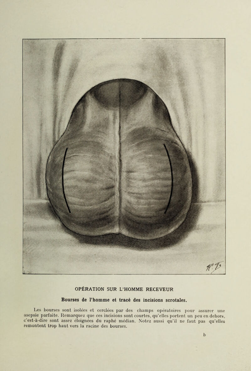 Bourses de l’homme et tracé des incisions scrotales. Les bourses sont isolées et cerclées par des champs opératoires pour assurer une asepsie parfaite. Remarquez que ces incisions sont courtes, qu’elles portent un peu en dehors, c’est-à-dire sont assez éloignées du raphé médian. Notez aussi qu’il ne faut pas qu’elles remontent trop haut vers la racine des bourses. b