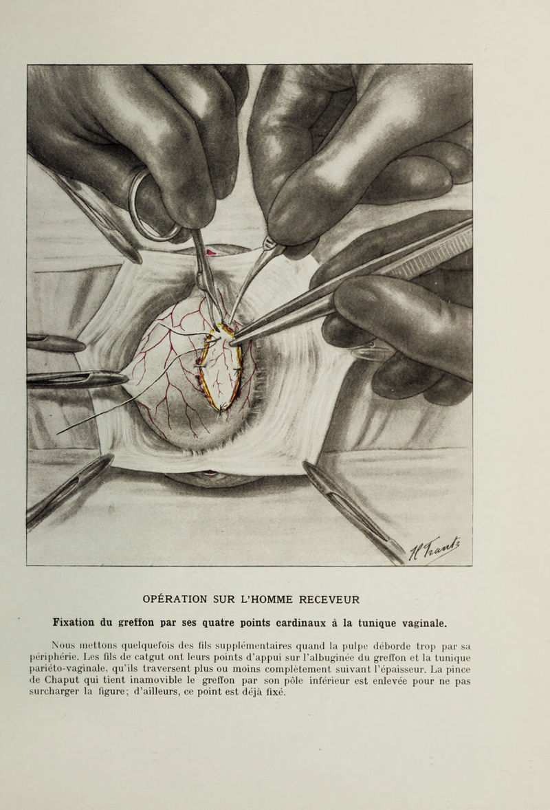 Fixation du greffon par ses quatre points cardinaux à la tunique vaginale. Nous mettons quelquefois des fils supplémentaires quand la pulpe déborde trop par sa périphérie. Les fds de catgut ont leurs points d’appui sur l’albuginée du greffon et la tunique pariéto-vaginale, qu’ils traversent plus ou moins complètement suivant l’épaisseur. La pince de Chaput qui tient inamovible le greffon par son pôle inférieur est enlevée pour ne pas surcharger la figure; d’ailleurs, ce point est déjà fixé.