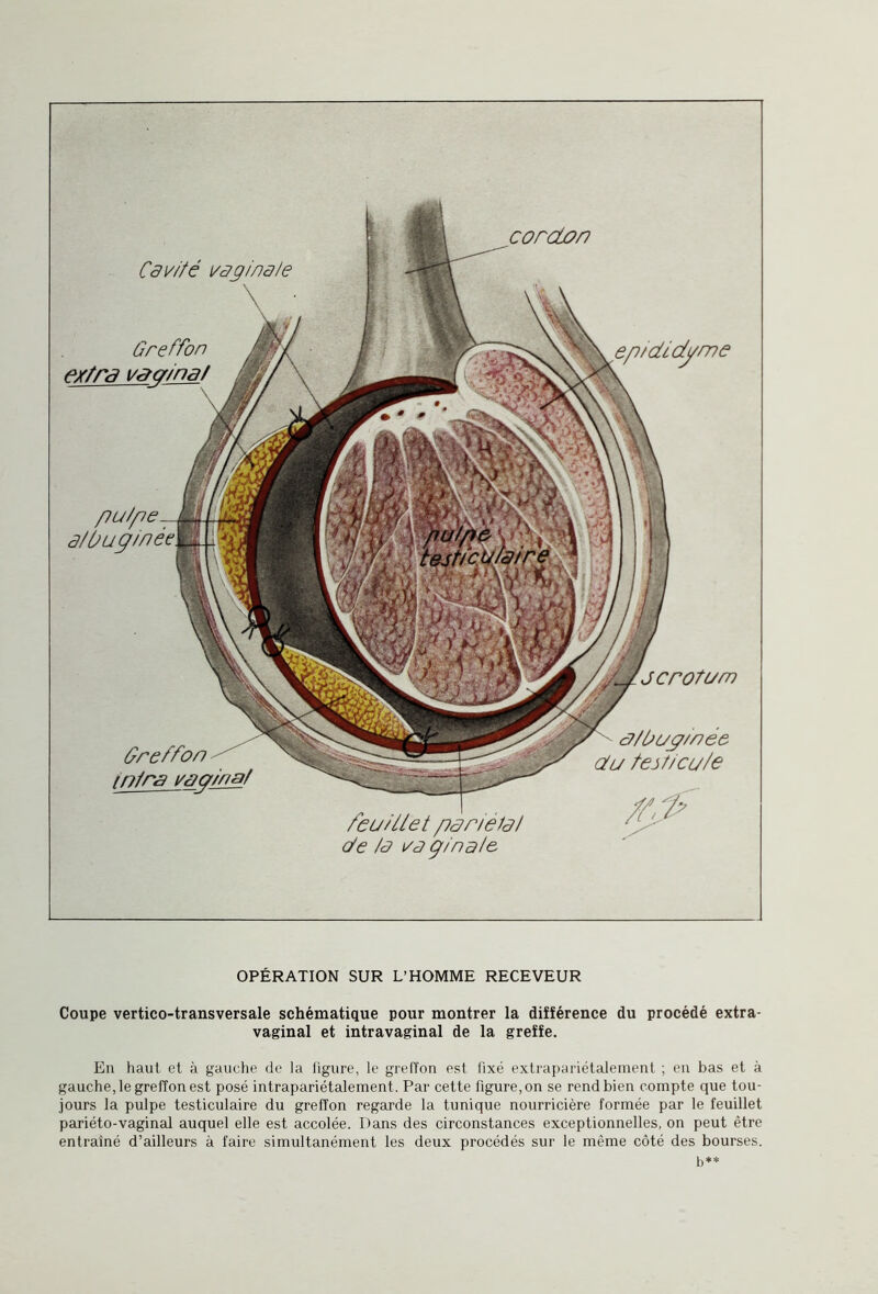 Cavité vaginale Greffon extra vaginat Greffon infra vay/nat J crûtc/m c/fOi/ÿ/née cfu test/eu/e cordon ep/didyme OPÉRATION SUR L’HOMME RECEVEUR Coupe vertico-transversale schématique pour montrer la différence du procédé extra¬ vaginal et intravaginal de la greffe. En haut et à gauche de la ligure, le greffon est fixé extrapariétalement ; en bas et à gauche, le greffon est posé intrapariétalement. Par cette figure, on se rend bien compte que tou¬ jours la pulpe testiculaire du greffon regarde la tunique nourricière formée par le feuillet pariéto-vaginal auquel elle est accolée. Dans des circonstances exceptionnelles, on peut être entraîné d’ailleurs à faire simultanément les deux procédés sur le même côté des bourses. b**