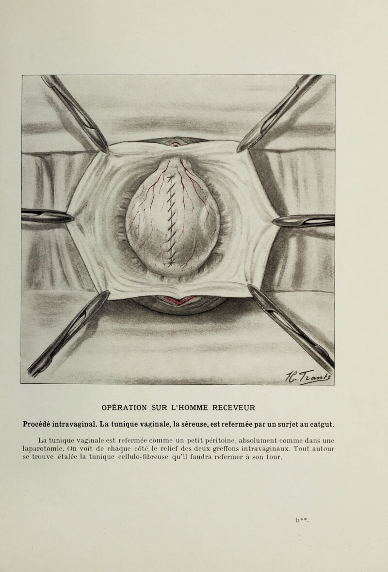Procédé intravaginal. La tunique vaginale, la séreuse, est refermée par un surjet au catgut. La tunique vaginale est refermée comme un petit péritoine, absolument comme dans une laparotomie. On voit de chaque côté le relief des deux greffons intravaginaux. Tout autour se trouve étalée la tunique cellulo-fibreuse qu’il faudra refermer à son tour.