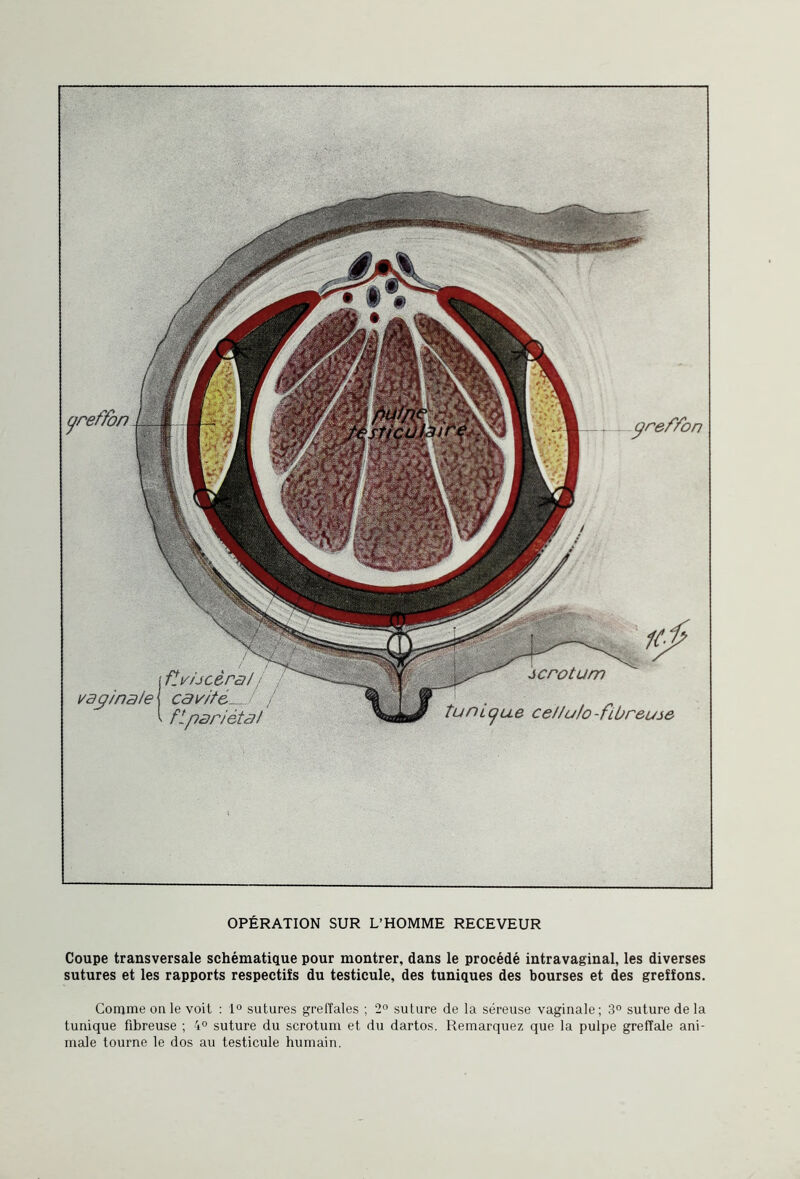 greffon vaginale flv/jcèra/ cavité fi pari étal tunique ceJ/u/o -fibreuse OPÉRATION SUR L’HOMME RECEVEUR Coupe transversale schématique pour montrer, dans le procédé intravaginal, les diverses sutures et les rapports respectifs du testicule, des tuniques des bourses et des greffons. Comme on le voit : 1° sutures greffales ; 2° suture de la séreuse vaginale; 3° suture de la tunique fibreuse ; 4° suture du scrotum et du dartos. Remarquez que la pulpe greffale ani¬ male tourne le dos au testicule humain.