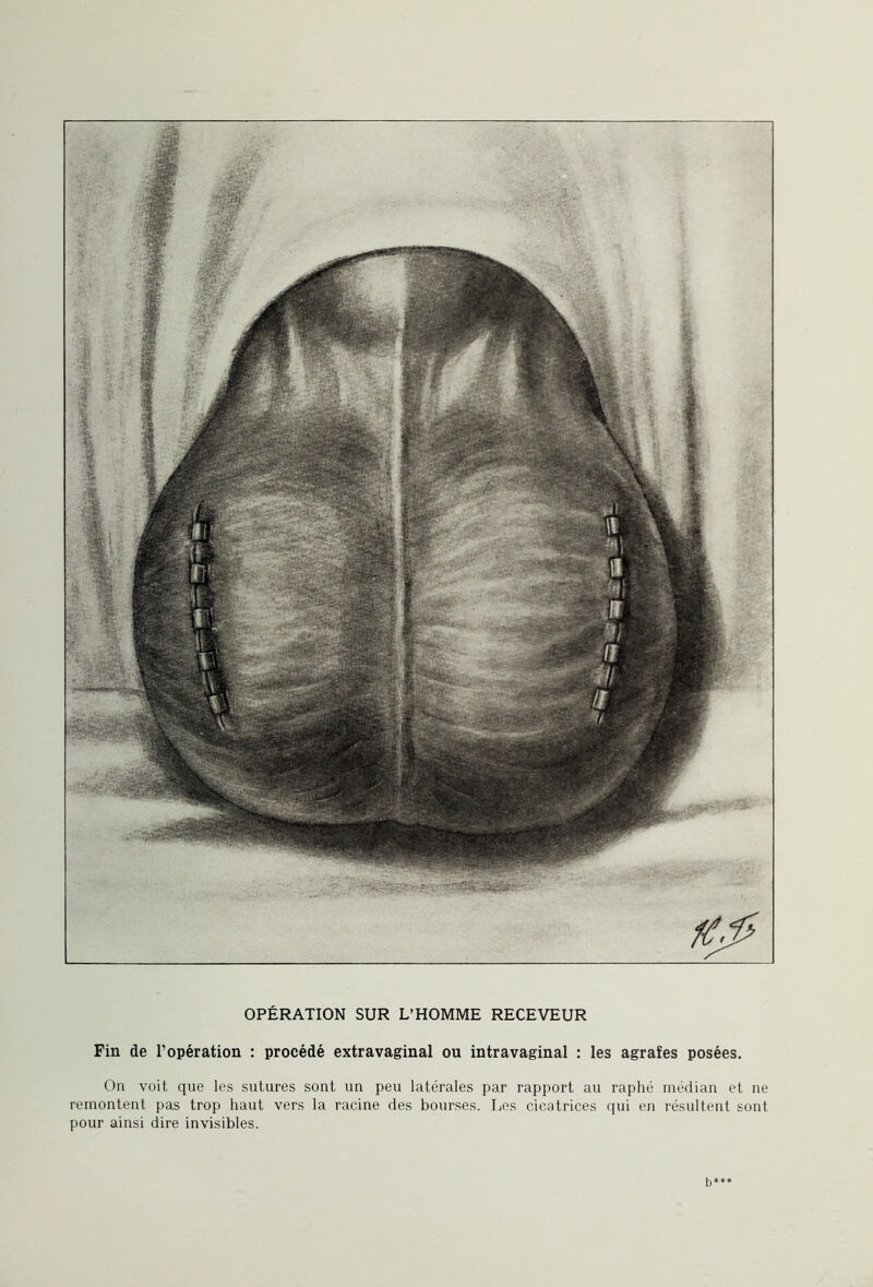 Fin de l’opération : procédé extravaginal ou intravaginal : les agrafes posées. On voit que les sutures sont un peu latérales par rapport au raphé médian et ne remontent pas trop haut vers la racine des bourses. Les cicatrices qui en résultent sont pour ainsi dire invisibles. b**»