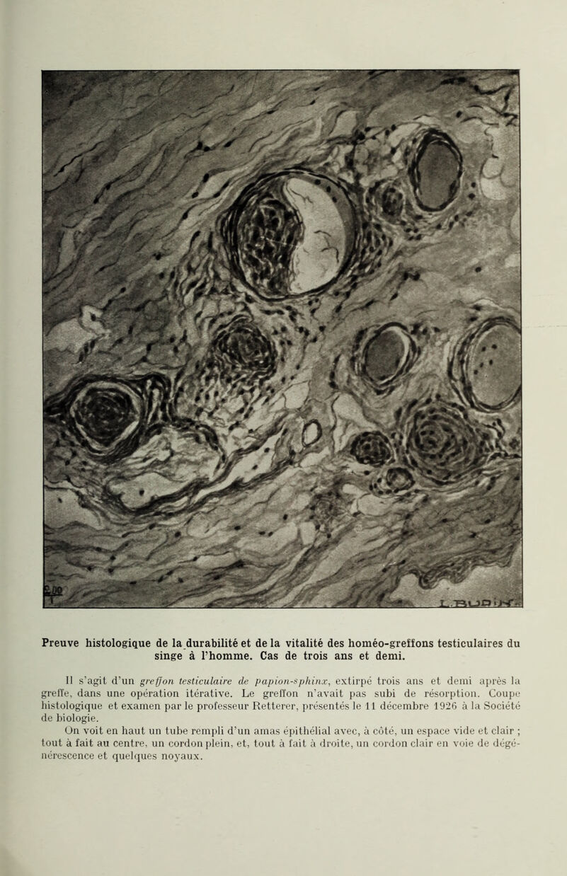 singe à l’homme. Cas de trois ans et demi. 11 s’agit d’un greffon testiculaire de papion-splii/ix, extirpé trois ans et demi après la greffe, dans une opération itérative. Le greffon n’avait pas subi de résorption. Coupe histologique et examen par le professeur Retterer, présentés le 11 décembre 1926 à la Société de biologie. Ün voit en haut un tube rempli d’un amas épithélial avec, à côté, un espace vide et clair ; tout à fait au centre, un cordon plein, et, tout à fait à droite, un cordon clair en voie de dégé¬ nérescence et quelques noyaux.