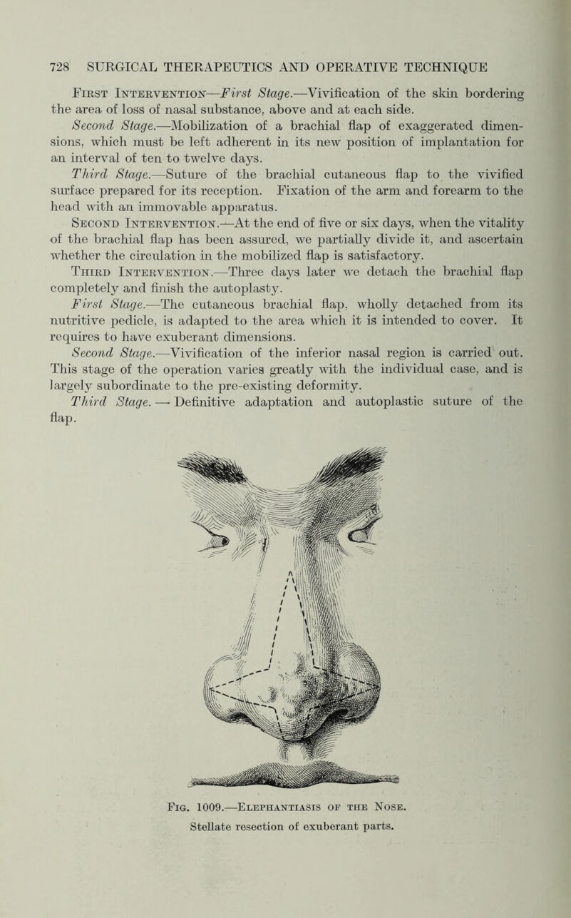 First Intervention-—First Stage.—Vivification of the skin bordering the area of loss of nasal substance, above and at each side. Second Stage.—Mobilization of a brachial flap of exaggerated dimen¬ sions, which must be left adherent in its new position of implantation for an interval of ten to twelve days. Third Stage.—Suture of the brachial cutaneous flap to the vivified surface prepared for its reception. Fixation of the arm and forearm to the head with an immovable apparatus. Second Intervention.—At the end of five or six days, when the vitality of the brachial flap has been assured, we partially divide it, and ascertain whether the circulation in the mobilized flap is satisfactory. Third Intervention.—Three days later we detach the brachial flap completely and finish the autoplasty. First Stage.—The cutaneous brachial flap, wholly detached from its nutritive pedicle, is adapted to the area which it is intended to cover. It requires to have exuberant dimensions. Second Stage.—Vivification of the inferior nasal region is carried out. This stage of the operation varies greatly with the individual case, and is largely subordinate to the pre-existing deformity. Third Stage. — Definitive adaptation and autoplastic suture of the flap. Fig. 1009.—Elephantiasis of the Nose. Stellate resection of exuberant parts.