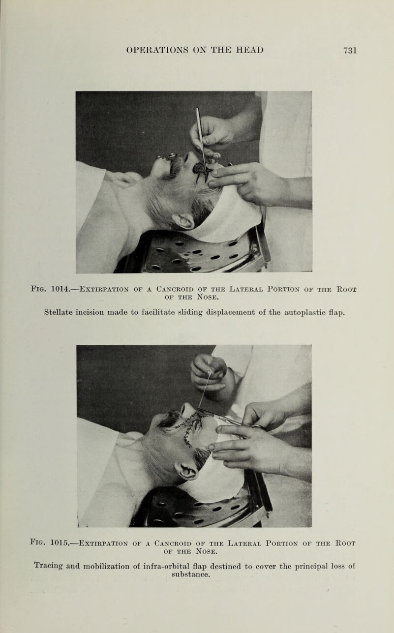 Fig. 1014.—Extirpation of a Cancroid of the Lateral Portion of the Root of the Nose. Stellate incision made to facilitate sliding displacement of the autoplastic flap. Fig. 1015.—Extirpation of a Cancroid of the Lateral Portion of the Root of the Nose. Tracing and mobilization of infra-orbital flap destined to cover the principal loss of substance.