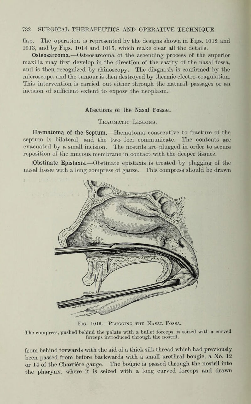 flap. The operation, is represented by the designs shown in Figs. 1012 and 1013, and by Figs. 1014 and 1015, which make clear all the details. Osteosarcoma.—Osteosarcoma of the ascending process of the superior maxilla may first develop in the direction of the cavity of the nasal fossa, and is then recognized by rhinoscopy. The diagnosis is confirmed by the microscope, and the tumour is then destroyed by thermic electro-coagulation. This intervention is carried out either through the natural passages or an incision of sufficient extent to expose the neoplasm. Affections of the Nasal Fossae. Traumatic Lesions. Haematoma of the Septum.—Haematoma consecutive to fracture of the septum is bilateral, and the two foci communicate. The contents are evacuated by a small incision. The nostrils are plugged in order to secure reposition of the mucous membrane in contact with the deeper tissues. Obstinate Epistaxis.—Obstinate epistaxis is treated by plugging of the nasal fossae with a long compress of gauze. This compress should be drawn Fig. 1016.—Plugging the Nasal Fossa. The compress, pushed behind the palate with a bullet forceps, is seized with a curved forceps introduced through the nostril. from behind forwards with the aid of a thick silk thread which had previously been passed from before backwards with a small urethral bougie, a No. 12 or 14 of the Charriere gauge. The bougie is passed through the nostril into the pharynx, where it is seized with a long curved forceps and drawn
