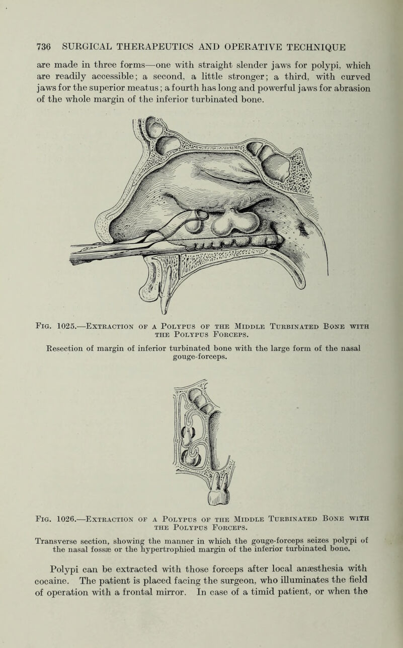 are made in three forms—one with straight slender jaws for polypi, which are readily accessible; a second, a little stronger; a third, with curved jaws for the superior meatus; a fourth has long and powerful jaws for abrasion of the whole margin of the inferior turbinated bone. Fig. 1025.—Extraction of a Polypus of the Middle Turbinated Bone with the Polypus Forceps. Resection of margin of inferior turbinated bone with the large form of the nasal gouge-forceps. Fig. 1026.—Extraction of a Polypus of the Middle Turbinated Bone with the Polypus Forceps. Transverse section, showing the manner in which the gouge-forceps seizes polypi of the nasal fossae or the hypertrophied margin of the inferior turbinated bone. Polypi can be extracted with those forceps after local anaesthesia with cocaine. The patient is placed facing the surgeon, who illuminates the field of operation with a frontal mirror. In case of a timid patient, or when the