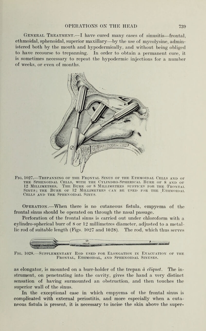 General Treatment.—I have cured many cases of sinusitis—frontal, ethmoidal, sphenoidal, superior maxillary—by the use of mycolysine, admin¬ istered both by the mouth and hypodermically, and without being obliged to have recourse to trepanning. In order to obtain a permanent cure, it is sometimes necessary to repeat the hypodermic injections for a number of weeks, or even of months. Fig. 1027.—Trepanning of the Frqntal Sinus of the Ethmoidal Cells and of the Sphenoidal Cells, with the Cylindro-Spherical Burr of 8 and of 12 Millimetres. The Burr of 8 Millimetres suffices for the Frontal Sinus; the Burr of 12 Millimetres can be used for the Ethmoidal Cells and the Sphenoidal Sinus. Operation.—When there is no cutaneous fistula, empyema of the frontal sinus should be operated on through the nasal passage. Perforation of the frontal sinus is carried out under chloroform with a cylindro-spherical burr of 8 or 12 millimetres diameter, adjusted to a metal¬ lic rod of suitable length (Figs. 1027 and 1028). The rod, which thus serves Fig. 1028.—Supplementary Rod used for Elongation in Evacuation of the Frontal, Ethmoidal, and Sphenoidal Sinuses. as elongator, is mounted on a burr-holder of the trepan a cliquet. The in¬ strument, on penetrating into the cavity, gives the hand a very distinct sensation of having surmounted an obstruction, and then touches the superior wall of the sinus. In the exceptional case in which empyema of the frontal sinus is complicated with external periostitis, and more especially when a cuta¬ neous fistula is present, it is necessary to incise the skin above the super-