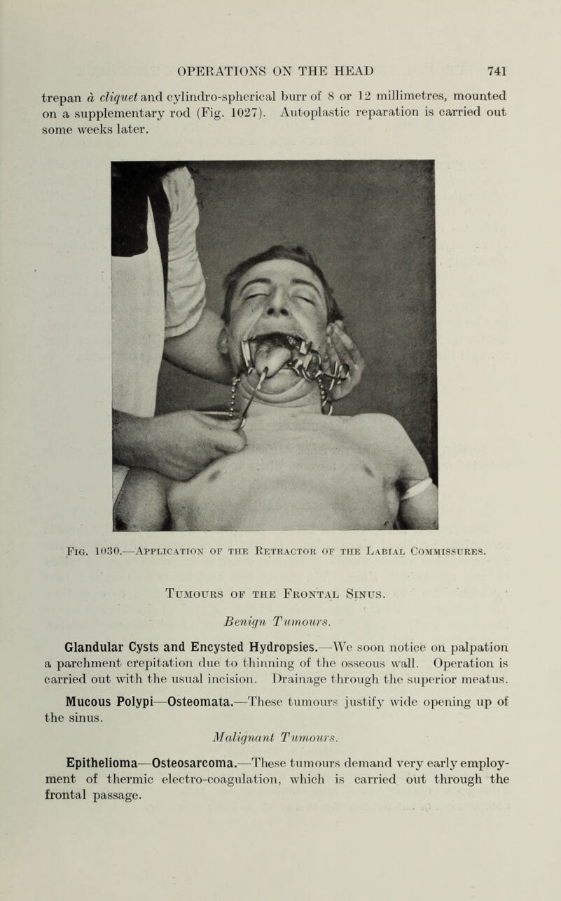 trepan d cliquet and cylindro-spherical burr of 8 or 12 millimetres, mounted on a supplementary rod (Fig. 1027). Autoplastic reparation is carried out some weeks later. Fig. 1030.—Application of the Retractor of the Labial Commissures. Tumours of the Frontal Sinus. Benign Tumours. Glandular Cysts and Encysted Hydropsies.—We soon notice on palpation a parchment, crepitation due to thinning of the osseous wall. (Operation is carried out with the usual incision. Drainage through the superior meatus. Mucous Polypi—Osteomata.—These tumours justify wide opening up of the sinus. Malignant Tumours. Epithelioma—Osteosarcoma.—These tumours demand very early employ¬ ment of thermic electro-coagulation, which is carried out through the frontal passage.