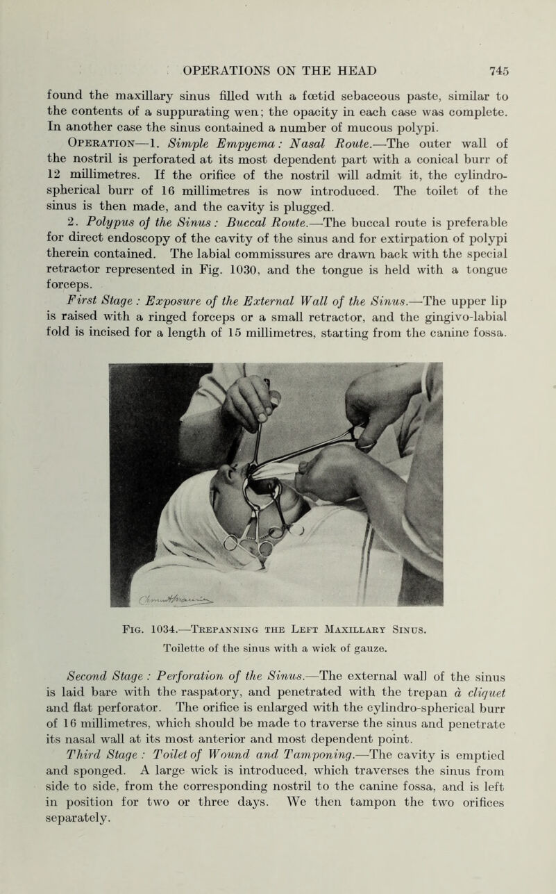 found the maxillary sinus filled with a foetid sebaceous paste, similar to the contents of a suppurating wen; the opacity in each case was complete. In another case the sinus contained a number of mucous polypi. Operation—1. Simple Empyema: Nasal Route.—The outer wall of the nostril is perforated at its most dependent part with a conical burr of 12 millimetres. If the orifice of the nostril will admit it, the cylindro- spherical burr of 16 millimetres is now introduced. The toilet of the sinus is then made, and the cavity is plugged. 2. Polypus of the Sinus: Buccal Route.—The buccal route is preferable for direct endoscopy of the cavity of the sinus and for extirpation of polypi therein contained. The labial commissures are drawn back with the special retractor represented in Fig. 1030, and the tongue is held with a tongue forceps. First Stage : Exposure of the External Wall of the Sinus.—The upper lip is raised with a ringed forceps or a small retractor, and the gingivo-labial fold is incised for a length of 15 millimetres, starting from the canine fossa. Fig. 1034.—Trepanning the Left Maxillary Sinus. Toilette of the sinus with a wick of gauze. Second Stage : P erf oration of the Sinus.—The external wall of the sinus is laid bare with the raspatory, and penetrated with the trepan a cliquet and flat perforator. The orifice is enlarged with the cylindro-spherical burr of 16 millimetres, which should be made to traverse the sinus and penetrate its nasal wall at its most anterior and most dependent point. Third Stage: Toilet of Wound and, Tamponing.—The cavity is emptied and sponged. A large wick is introduced, which traverses the sinus from side to side, from the corresponding nostril to the canine fossa, and is left in position for two or three days. We then tampon the two orifices separately.