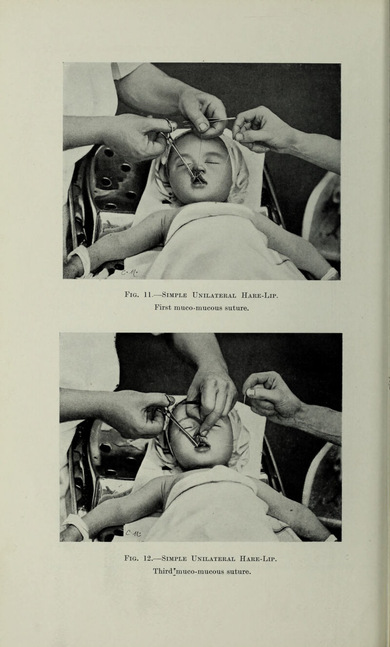 Fig. 12.—Simple Unilateral Hare-Lip. ThircUmuco-mucous suture. Fig. 11.—Simple Unilateral Hare-Lip. First muco-mucous suture.