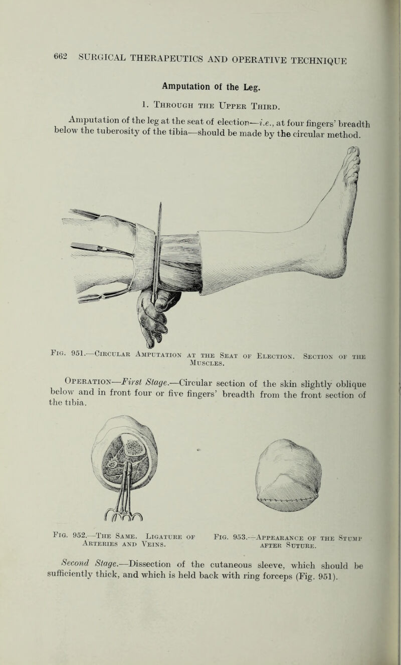 Amputation of the Leg. 1. Through the Upper Third. Amputation of the leg at the seat of election—i.e., at four fingers’ breadth below the tuberosity of the tibia—should be made by the circular method. Fig. 951. Circular Amputation at the Seat of Election. Section of the Muscles. Operation First Stage.—Circular section of the skin slightly oblique belon and in front four or five fingers breadth from the front section of the tibia. 1 ig. 952. The Same. Ligature of Fig. 953.—Appearance of the Stump Arteries and Veins. after Suture. Second Stage.—Dissection of the cutaneous sleeve, which should be sufficiently thick, and which is held back with ring forceps (Fig. 951).