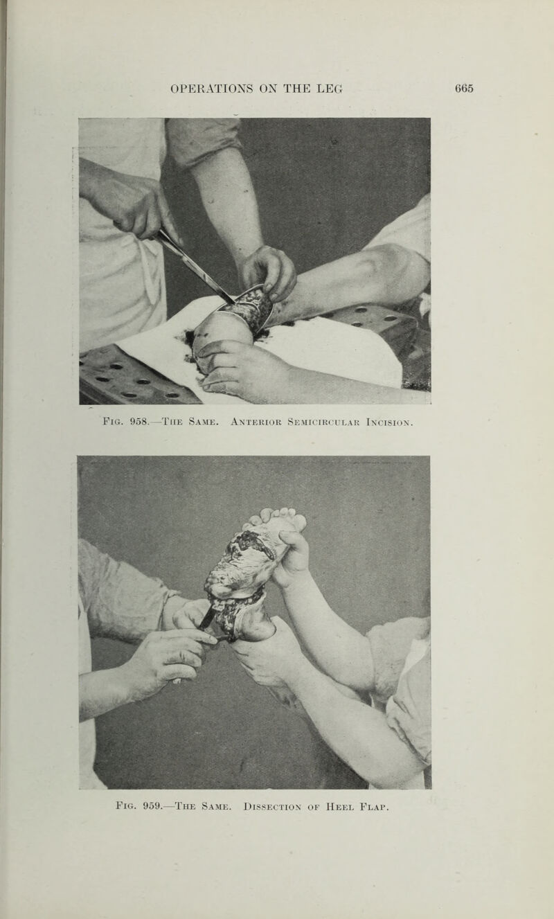 Fig. 959.—The Same. Dissection of Heel Flap.