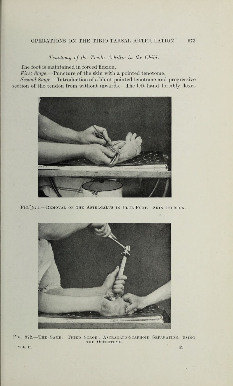 Tenotomy of the Tendo A chillis in the Child. The foot is maintained in forced flexion. First Stage.—Puncture of the skin with a pointed tenotome. Second Stage.—Introduction of a blunt-pointed tenotome and progressive section of the tendon from without inwards. The left hand forcibly flexes Fig.'971.—Removal of the Astragalus in Club-Foot. Skin Incision. Fig. 972.—The Same. Third Stage : Astragalo-Scaphoid Separation, using the Osteotome. VOL. II. 43