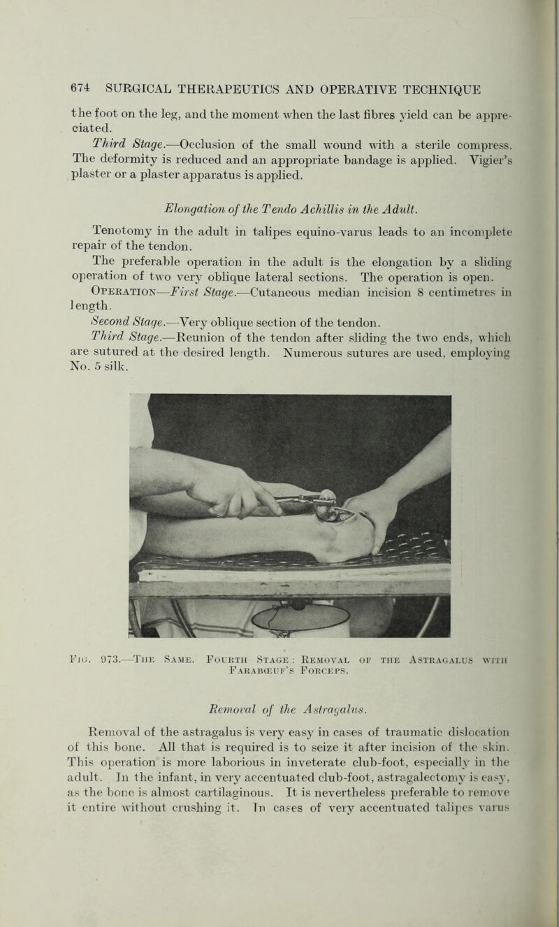 the foot on the leg, and the moment when the last fibres yield can be appre¬ ciated. Third Stage.—Occlusion of the small wound with a sterile compress. The deformity is reduced and an appropriate bandage is applied. Vigier’s plaster or a plaster apparatus is applied. Elongation of the Tendo Achillis in the Adult. Tenotomy in the adult in talipes equino-varus leads to an incomplete repair of the tendon. The preferable operation in the adult is the elongation by a sliding- operation of two very oblique lateral sections. The operation is open. Operation—First Stage.—Cutaneous median incision 8 centimetres in length. Second Stage.—Very oblique section of the tendon. Third Stage.—Reunion of the tendon after sliding the two ends, which are sutured at the desired length. Numerous sutures are used, employing No. 5 silk. Fig. 973.—The Same. Fourth Stage : Removal of the Astragalus with Farabceuf’s Forceps. Removal of the Astragalus. Removal of the astragalus is very easy in cases of traumatic dislocation of this bone. All that is required is to seize it after incision of the skin. This operation is more laborious in inveterate club-foot, especially in the adult. In the infant, in very accentuated club-foot, astragalectomy is eas3% as the bone is almost cartilaginous. It is nevertheless preferable to remove it entire without crushing it. Tn cases of very accentuated talipes varus