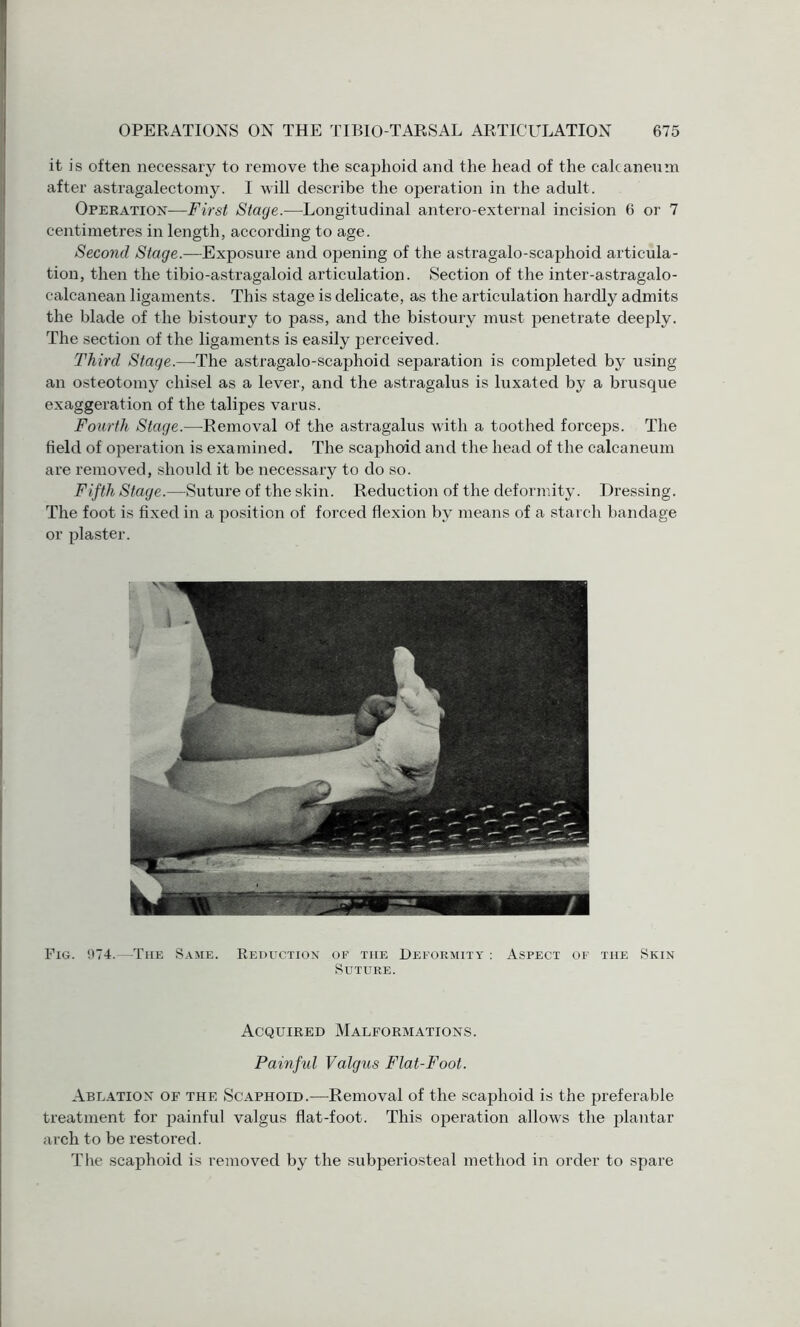 it is often necessary to remove the scaphoid and the head of the calcaneum after astragalectomy. I will describe the operation in the adult. Operation—First Stage.—Longitudinal antero-external incision 6 or 7 centimetres in length, according to age. Second Stage.—Exposure and opening of the astragalo-scaphoid articula¬ tion, then the tibio-astragaloid articulation. Section of the inter-astragalo- calcanean ligaments. This stage is delicate, as the articulation hardly admits the blade of the bistoury to pass, and the bistoury must penetrate deeply. The section of the ligaments is easily perceived. Third Stage.—-The astragalo-scaphoid separation is completed by using an osteotomy chisel as a lever, and the astragalus is luxated by a brusque exaggeration of the talipes varus. Fourth Stage.—Removal of the astragalus with a toothed forceps. The field of operation is examined. The scaphoid and the head of the calcaneum are removed, should it be necessary to do so. Fifth Stage.—-Suture of the skin. Reduction of the deformity. Dressing. The foot is fixed in a position of forced flexion by means of a starch bandage or plaster. Fig. 974.—The Same. Reduction of the Deformity : Aspect of the Skin Suture. Acquired Malformations. Painful Valgus Flat-Foot. Ablation of the Scaphoid.—Removal of the scaphoid is the preferable treatment for painful valgus flat-foot. This operation allows the plantar arch to be restored. The scaphoid is removed by the subperiosteal method in order to spare