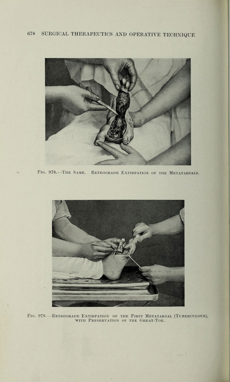 Fig. 978.—The Same. Retrograde Extirpation of the Metatarsals. Fig. 979.—Retrograde Extirpation of the First Metatarsal (Tuberculous), with Preservation of the Great-Toe.