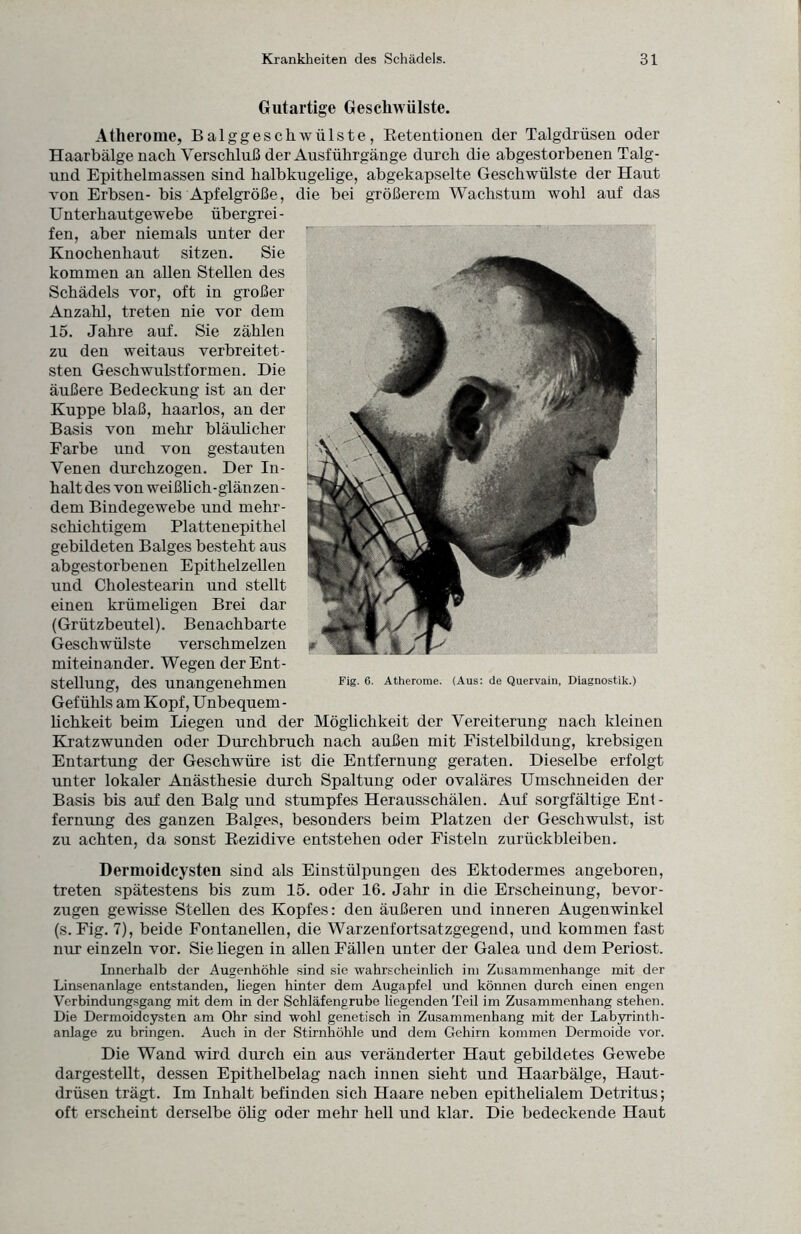 Gutartige Geschwülste. Atherome, Balggeschwülste, Retentionen der Talgdrüsen oder Haarbälge nach Verschluß der Ausführgänge durch die abgestorbenen Talg- und Epithelmassen sind halbkugelige, abgekapselte Geschwülste der Haut von Erbsen- bis Apfelgröße, die bei größerem Wachstum wohl auf das Unterhautgewebe übergrei¬ fen, aber niemals unter der Knochenhaut sitzen. Sie kommen an allen Stellen des Schädels vor, oft in großer Anzahl, treten nie vor dem 15. Jahre auf. Sie zählen zu den weitaus verbreitet¬ sten Geschwulstformen. Die äußere Bedeckung ist an der Kuppe blaß, haarlos, an der Basis von mehr bläulicher Farbe und von gestauten Venen durchzogen. Der In¬ halt des von weißlich-glänzen¬ dem Bindegewebe und mehr¬ schichtigem Plattenepithel gebildeten Balges besteht aus abgestorbenen Epithelzellen und Cholestearin und stellt einen krümeligen Brei dar (Grützbeutel). Benachbarte Geschwülste verschmelzen miteinander. Wegen der Ent¬ stellung, des unangenehmen Gefühls am Kopf, Unbequem - lichkeit beim Liegen und der Möglichkeit der Vereiterung nach kleinen Kratzwunden oder Durchbruch nach außen mit Fistelbildung, krebsigen Entartung der Geschwüre ist die Entfernung geraten. Dieselbe erfolgt unter lokaler Anästhesie durch Spaltung oder ovaläres Umschneiden der Basis bis auf den Balg und stumpfes Herausschälen. Auf sorgfältige Ent¬ fernung des ganzen Balges, besonders beim Platzen der Geschwulst, ist zu achten, da sonst Rezidive entstehen oder Fisteln Zurückbleiben. Dermoidcysten sind als Einstülpungen des Ektodermes angeboren, treten spätestens bis zum 15. oder 16. Jahr in die Erscheinung, bevor¬ zugen gewisse Stellen des Kopfes: den äußeren und inneren Augenwinkel (s. Fig. 7), beide Fontanellen, die Warzenfortsatzgegend, und kommen fast nur einzeln vor. Sie hegen in allen Fällen unter der Galea und dem Periost. Linerhalb der Augenhöhle sind sie wahrscheinlich im Zusammenhänge mit der Linsenanlage entstanden, liegen hinter dem Augapfel und können durch einen engen Verbindungsgang mit dem in der Schläfengrube liegenden Teil im Zusammenhang stehen. Die Dermoidcysten am Ohr sind wohl genetisch in Zusammenhang mit der Labyrinth¬ anlage zu bringen. Auch in der Stirnhöhle und dem Gehirn kommen Dermoide vor. Die Wand wird durch ein aus veränderter Haut gebildetes Gewebe dargestellt, dessen Epithelbelag nach innen sieht und Haarbälge, Haut¬ drüsen trägt. Im Inhalt befinden sich Haare neben epithelialem Detritus; oft erscheint derselbe ölig oder mehr hell und klar. Die bedeckende Haut Fig. 6. Atherome. (Aus: de Quervain, Diagnostik.)